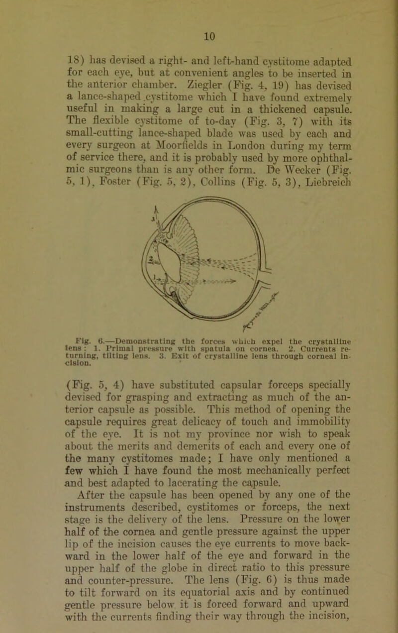 18) lias devised a right- and left-hand cystitome adapted for each eye, but at convenient angles to be inserted in the anterior chamber. Ziegler (Fig. 4, 19) has devised a lance-shaped .cystitome which I have found extremely useful in making a large cut in a thickened capsule. The flexible cystitome of to-day (Fig. 3, 7) with its small-cutting lance-shaped blade was used by each and every surgeon at Moorfields in London during my term of service there, and it is probably used by more ophthal- mic surgeons than is any other form. Be Wecker (Fig. 5, 1), Foster (Fig. 5, 2), Collins (Fig. 5, 3), Liebreich Kig. 0.—Demonstrating the forces which expel the crystalline tens : 1. l’rimnl pressure with spatula on cornea. 2. Currents re- turning, tilting lens. 3. Exit of crystalline lens through corneal In- cision. (Fig. 5, 4) have substituted capsular forceps specially devised for grasping and extracting as much of the an- terior capsule as possible. This method of opening the capsule requires great delicacy of touch and immobility of the eye. It is not my province nor wish to speak about the merits and demerits of each and every one of the many cystitomes made; I have only mentioned a few which 1 have found the most mechanically perfect and best adapted to lacerating the cgpsule. After the capsule has been opened by any one of the instruments described, cystitomes or forceps, the next stage is the delivery of the lens. Pressure on the lower half of the cornea and gentle pressure against the upper lip of the incision causes the eye currents to move back- ward in the lower half of the eye and forward in the upper half of the globe in direct ratio to this pressure and counter-pressure. The lens (Fig. 6) is thus made to tilt forward on its equatorial axis and by continued gentle pressure below it is forced forward and upward with the currents finding their way through the incision,