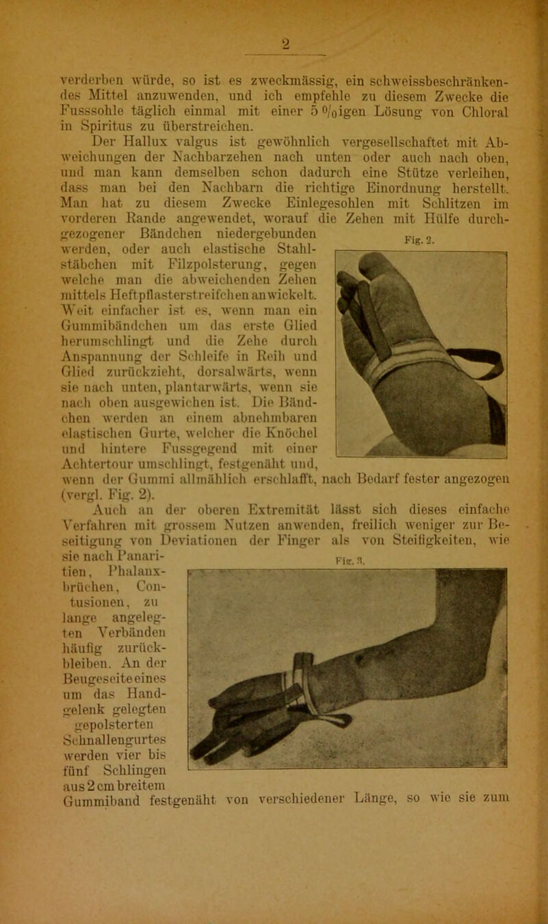 verderben würde, so ist es zweckmässig, ein schweissbeschränken- des Mittel anzuwenden, und ich empfehle zu diesem Zwecke die Fusssohle täglich einmal mit einer 5 0/0igen Lösung von Chloral in Spiritus zu überstreichen. Der Hallux valgus ist gewöhnlich vergesellschaftet mit Ab- weichungen der Nachbarzehen nach unten oder auch nach oben, und man kann demselben schon dadurch eine Stütze verleihen, dass man bei den Nachbarn die richtige Einordnung herstellt. Man hat zu diesem Zwecke Einlegesohlen mit Schlitzen im vorderen Rande angewendet, worauf die Zehen mit Hülfe durch- gezogener Bändchen niedergebunden werden, oder auch elastische Stahl- stäbchen mit Filzpolsterung, gegen welche man die abweichenden Zehen mittels Heftpflasterst reifchen an wickelt. Weit einfacher ist es, wenn man ein Gummibändchen um das erste Glied herumschlingt und die Zehe durch Anspannung der Schleife in Reih und Glied zurückzieht, dorsalwärts, wenn sie nach unten, plantarwärts, wenn sie nach oben ausgewichen ist. Die Bänd- chen werden an einem abnehmbaren elastischen Gurte, welcher die Knöchel und hintere Fussgegend mit einer Achtertour umschlingt, festgenäht und, wenn der Gummi allmählich erschlafft, nach Bedarf festor angezogen (vergl. Fig. 2). Auch an der oberen Extremität lässt sich dieses einfache Verfahren mit grossem Nutzen an wenden, freilich weniger zur Be- seitigung von Deviationen der Finger als von Steifigkeiten, wie sie nach Panari- tien, Phalaux- brüchen, Con- tusionen, zu lange angeleg- ten Verbänden häufig Zurück- bleiben. An der Beugeseiteeines um das Hand- gelenk gelegten gepolsterten Schnallengurtes werden vier bis fünf Schlingen Gummiband festgenäht von verschiedener Länge, so wie sie zum Kie. n.