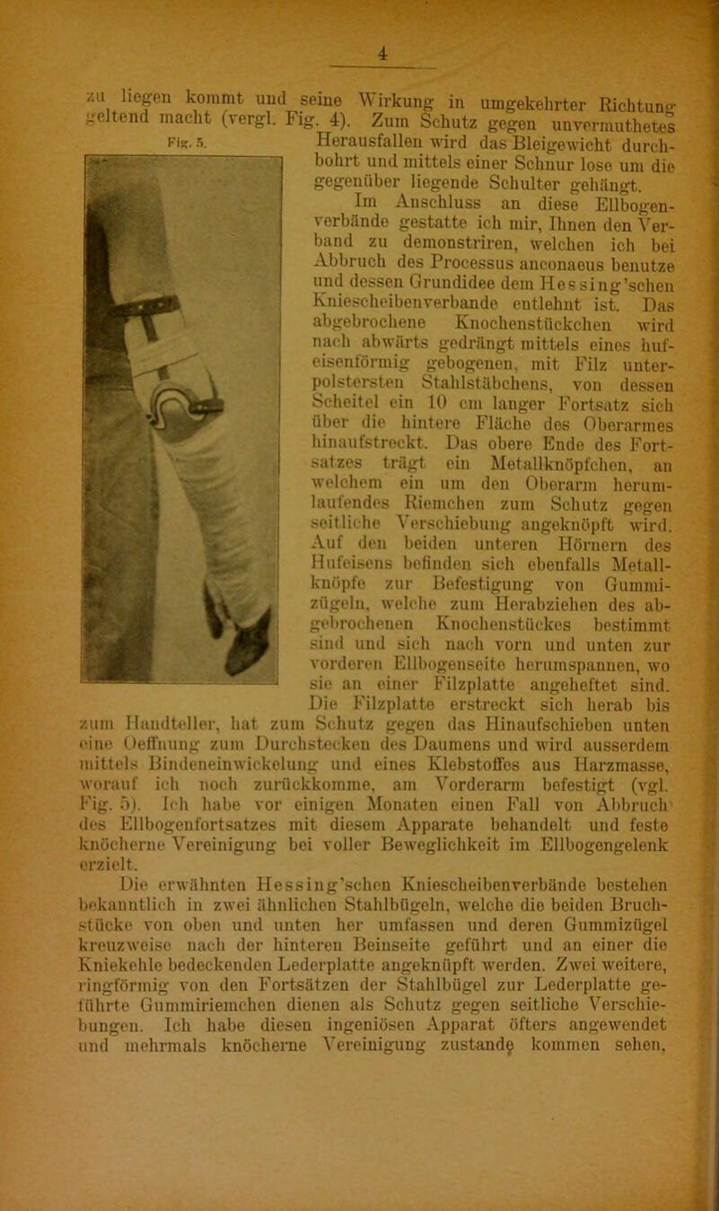 /.u Jicgdi kommt und seine Wirkung in umgekehrter Richtung geltend macht (vergl. Fig. 4). Zum Schutz FiK. 5. gegen unvermutlietes Herausfallen wird das Bleigewicht durch- bohrt und mittels einer Schnur lose um die gegenüber liegende Schulter gehängt. Im Anschluss an diese Ellbogen- verbände gestatte ich mir, Ihnen den Ver- band zu demonstriren, welchen ich bei Abbruch dos Processus anconaous benutze und dessen Grundidee dem Hessing’schen Kniescheibenverbande entlehnt ist. Das abgebrochene Knochenstückchen wird nach abwärts gedrängt mittels eines huf- eisenförmig gebogenen, mit Filz unter- polstersten Stahlstäbchens, von dessen Scheitel ein 10 cm langer Fortsatz sich über die hintere Fläche des Oberarmes hinaufstreckt. Das obere Ende des Fort- wHugra satzes trägt ein Metallknöpfchen, an welchem ein um den Oberarm herum- laufendes Riemchen zum Schutz gegen seitliche Verschiebung angeknöpft wird. Auf den beiden unteren Hörnern des Hufeisens befinden sich ebenfalls Metall- knöpfo zur Befestigung von Gummi- zügeln, welche zum Herabziehen des ab- gebrochenen Knochenstückes bestimmt sind und sich nach vorn und unten zur vorderen Ellbogenseite herumspannen, wo sie an einer Filzplatte angeheftet sind. Die Filzplatte erstreckt sich herab bis zum Handteller, hat zum Schutz gegen das Hinaufschieben unten eine Oeffnung zum Durchstecken des Daumens und wird ausserdem mittels Bindeneinwickelung und eines Klebstoffes aus Harzmasse, worauf ich noch zurückkomme, am Vorderarm befestigt (vgl. Fig. 5). Ich habe vor einigen Monaten einen Fall von Abbruch des Ellbogenfortsatzes mit diesem Apparate behandelt und feste knöcherne Vereinigung bei voller Beweglichkeit im Ellbogongelenk erzielt. Die erwähnten Hessing’schen Kniescheibenrerbände bestehen bekanntlich in zwei ähnlichen Stahlbügeln, welche die beiden Bruch- stücke von oben und unten her umfassen und deren Gummizügel kreuzweise nach der hinteren Beinseite geführt und an einer die Kniekehle bedeckenden Lederplatte angeknüpft werden. Zwei weitere, ringförmig von den Fortsätzen der Stahlbügel zur Lederplatte go- Gummiriemchen dienen als Schutz gegen seitliche Verschie- Ich habe diesen ingeniösen Apparat öfters angewendet und mehrmals knöcherne Vereinigung zustande kommen sollen, Ö führte bungen.