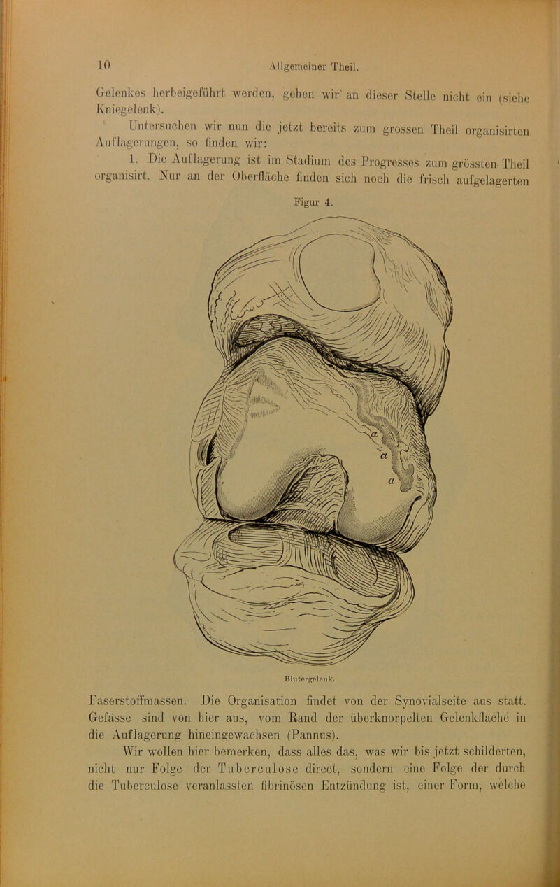 Gelenkes licrbeigefiilirt werden, gelien wir' an dieser Stelle nicht ein (siehe Kniegelenk). ' Untersuchen wir mm die jetzt bereits zum grossen Theil organisirten Auriagerungen, so linden wir: 1. Die Auflagerung ist im Stadium des Progresses zum grössten-Theil oiganisiit. ^ui an dei Obeillächc finden sich noch die frisch aufgclagerten Figur 4. Bliitergelonk. Faserstoffmassen. Die Organisation findet von der Synovialseitc aus statt. Gefässe sind von hier aus, vom Rand der überknorpelten Gelenklläche in die Auflagerung hineingewachsen (Pannus). Wir wollen hier bemerken, dass alles das, was wir bis jetzt schilderten, nicht nur Folge der Tuberculose direct, sondern eine Folge der durch die Tuberculose veranlassten libi-inösen Entzündung ist, einer Form, wölche