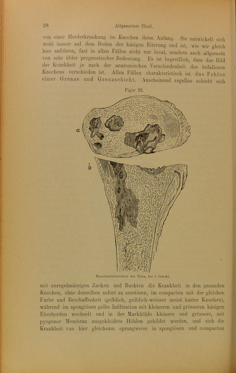 von einer Herderkrankung im Knoclien iliron Anfang. Sie enLwiokelt sich wolil immer auf dem Hoden der käsigen Eiterung und ist, wie wir gleich liier anfüliren, fast in allen Fällen nicht nur local, sondern auch allgemein von sehr übler prognostischer Bedeutung. Es ist begreiflich, dass das Bild der Krankheit je nach der anatomischen Verscliiedcnheit des befallenen Knochens verschieden ist. Allen Fällen charakteristisch ist das Fehlen einer Grenze und Grenzschicht. Anscheinend regellos schiebt sich Figur 23. Kuochentiiberculoso der Tibia, bei b Infarkt. mit unregelmässigen Zacken und Buchten die Krankheit in den gesunden Knochen, ohne denselben sofort zu zerstören, im compacten mit der gleichen Farbe und Beschaffenheit (gelblich, gelblich-weisser meist harter Knochen), während im spongiösen gelbe Infdtration mit kleineren und grösseren käsigen Eiterherden wechselt und in der Markhöhle kleinere und grössere, mit pyogener Membran ausgekleidcte Höhlen gebildet werden, und sich die Krankheit von hier gleichsam sprungweise in spongiösen und compacten