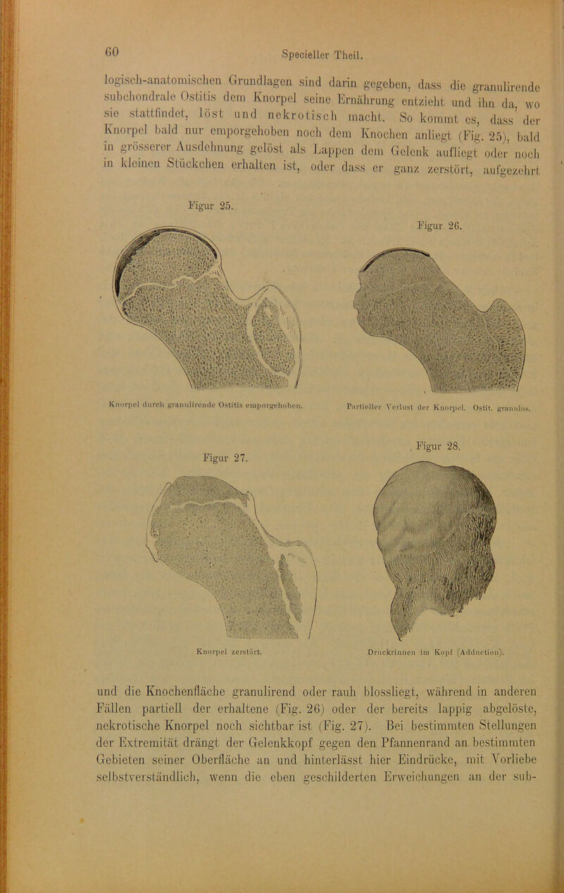 fiO logiseli-anatomischen Grundlagen sind darin gegeben, dass die granulirende subchondrale Ostitis dem Knorpel seine Ernährung entzieht und ihn da wo sie statthndet, lost und nekrotisch macht. So kommt cs, dass' der Knorpel bald nur emporgehoben noch dem Knochen anliegt (Fig. 25;, bald in grösserer Ausdehnung gelöst als Lappen dem Gelenk aufliegt oder noch in kleinen Stückchen erhalten ist, oder dass er ganz zerstört, aufgezehrt Figur 25. Kiinrpel (liircli Kn*»nl>ren<le Ostitis om|)orj?ehi>l)oii. Figur 2G. Ptiiticllpi- VeiUist der Knorjiol. Ostit. ('riimilns. Figur 27. Knorpel zerstört. Figur 28. Druckrinnen im Kopf (Adduction). und die Knochenfläche granulirend oder rauh blossliegt, während in anderen Fällen partiell der erhaltene (Fig. 26) oder der bereits lappig abgelöstc, nekrotische Knorpel noch sichtbar ist (Fig. 27). Bei bestimmten Stellungen der Extremität drängt der Gelenkkopf gegen den Pfannenrand an bestimmten Grebieten seiner Oberfläche an und hinterlässt hier Eindrücke, mit Vorliebe selbstverständlich, wenn die eben geschilderten Erweichungen an der sub-