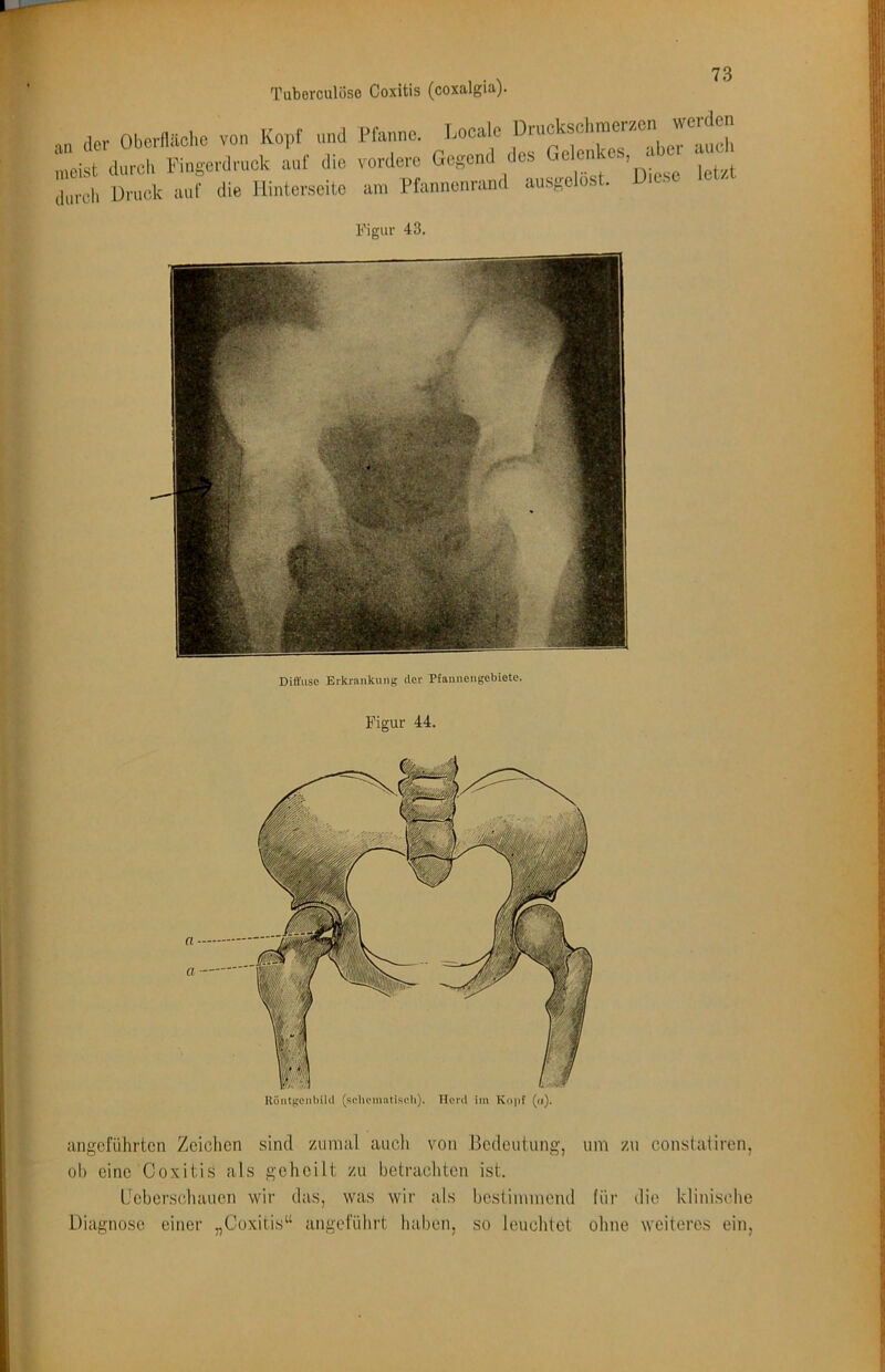 an der Oberfläche von Kopf und Pfanne. Locale meist durch Fingerdruck auf die vordere Gegend des Gelen , ^ tick auf die lUnterseite am Pfannenrand ausgelöst. D.ese let/.t Figur 43. Diffuse Erkrankung der Pfannengebiete. Figur 44. RöntgenbiUl (selienuiliseli). Herd iin Kojjf (n). angeführten Zeichen sind zumal auch von Bedeutung, ob eine Coxitis als geheilt zu betrachten ist. IJcberschauen wir d:is, was wir als bestimmend Diagnose einer „Coxitis“ angeführt haben, so leuchtet um zu constatiren, für die klinische ohne weiteres ein,