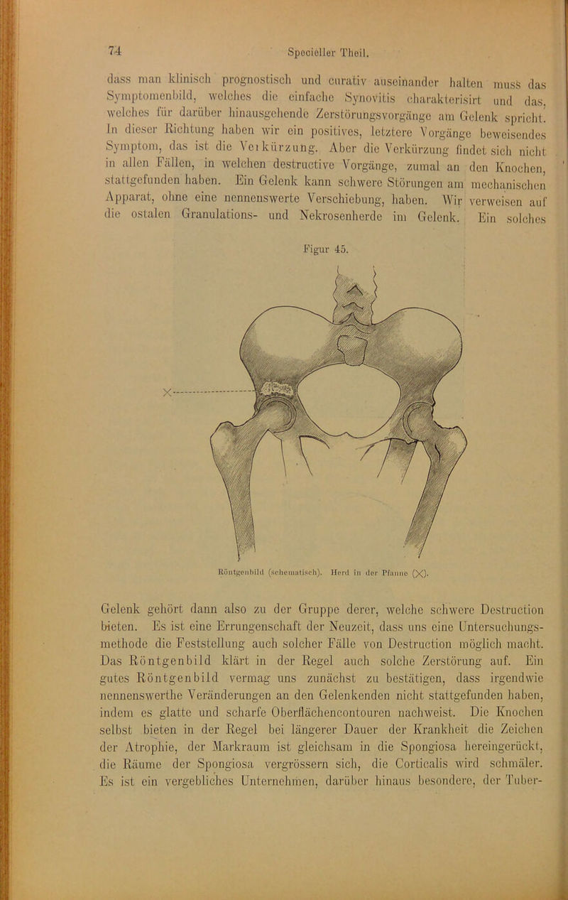 dass man klinisch prognostiscli und cnrativ auseinander lialten muss das Symptomenbild, welches die einfaclie Synovitis cliaraklorisirt und das welclies (ur darüber binausgehende Zerstörungsvorgänge am Gelenk spricht! In dieser Kichtung haben wir ein positiv^es, letztere Vorgänge beweisendes Symptom, das ist die Yeikürzung. Aber die Verkürzung findet sich nicht in allen Fällen, in welchen destructive Vorgänge, zumal an den Knoclien, stattgefunden haben. Ein Gelenk kann schwere Störungen am mechanischen Apparat, ohne eine nennenswerte Verschiebung, haben. Wir verweisen auf die ostalen Granulations- und Nekrosenherde im Gelenk. Ein solches Figur 45. Gelenk gehört dann also zu der Gruppe derer, welche schwere Destruction bieten. Es ist eine Errungenschaft der Neuzeit, dass uns eine IJntersuchungs- methode die Feststellung auch solcher Fälle von Destruction möglich macht. Das Röntgenbild klärt in der Regel auch solche Zerstörung auf. Ein gutes Röntgenbild vermag uns zunächst zu bestätigen, dass irgendwie nennenswerthe Veränderungen an den Gelenkenden nicht stattgefunden haben, indem es glatte und scharfe Oberflächencontouren nachweist. Die Knochen selbst bieten in der Regel bei längerer Dauer der Krankheit die Zeichen der Atrophie, der Markraum ist gleichsam in die Spongiosa hereingerückt, die Räume der Spongiosa vergrössern sich, die Corticalis wird schmäler. Es ist ein vergebliches Unternehmen, darüber hinaus besondere, der Tuber-