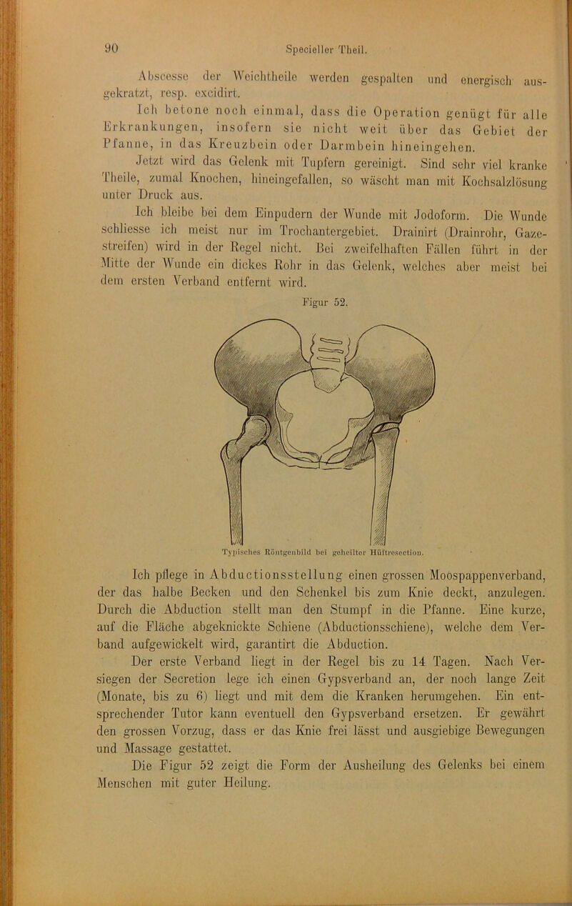 AbscGSSC dor Wcichtlieilo werden gespidlen und energiscli nus- gekratzt, resp. excidirt. Icli betone noch einmal, dass die Operation genügt für alle Erkrankungen, insofern sie nicht weit über das Gebiet der Pfanne, in das Kreuzbein oder Darmbein liineingelien. Jetzt wird das Gelenk mit Tupfern gereinigt. Sind sehr viel kranke Iheile, zumal Knochen, hineingefallen, so wäscht man mit Kochsalzlösung unter Druck aus. Ich bleibe bei dem Einpudern der Wunde mit Jodoform. Die Wunde schliesse ich meist nur im Trochantergebiet. Drainirt (Drainrohr, Gaze- streifen) wird in der Regel nicht. Bei zweifelhaften Fällen fülirt in der (Mitte der Wunde ein dickes Roiir in das Gelenk, welches aber meist bei dem ersten Verband entfernt wird. Figur 52. Tyiiisches Röiitgoiibild bei gobeilter Hüftrosection. Ich pflege in Abductionsstellung einen grossen Moospappenverband, der das halbe Becken und den Schenkel bis zum Knie deckt, anzulegen. Durch die Abduction stellt man den Stumpf in die Pfanne. Eine kurze, auf die Fläche abgeknickte Schiene (Abductionsschiene), welche dem Ver- band aufgewickelt wird, garantirt die Abduction. Der erste Verband liegt in der Regel bis zu 14 Tagen. Nach Ver- siegen der Secretion lege ich einen Gypsverband an, der noch lange Zeit (Monate, bis zu 6) liegt und mit dem die Kranken herumgehen. Ein ent- sprechender Tutor kann eventuell den Gypsverband ersetzen. Er gewährt den grossen Vorzug, dass er das Knie frei lässt und ausgiebige Bewegungen und Massage gestattet. Die Figur 52 zeigt die Form der Ausheilung des Gelenks bei einem Menschen mit guter Heilung.