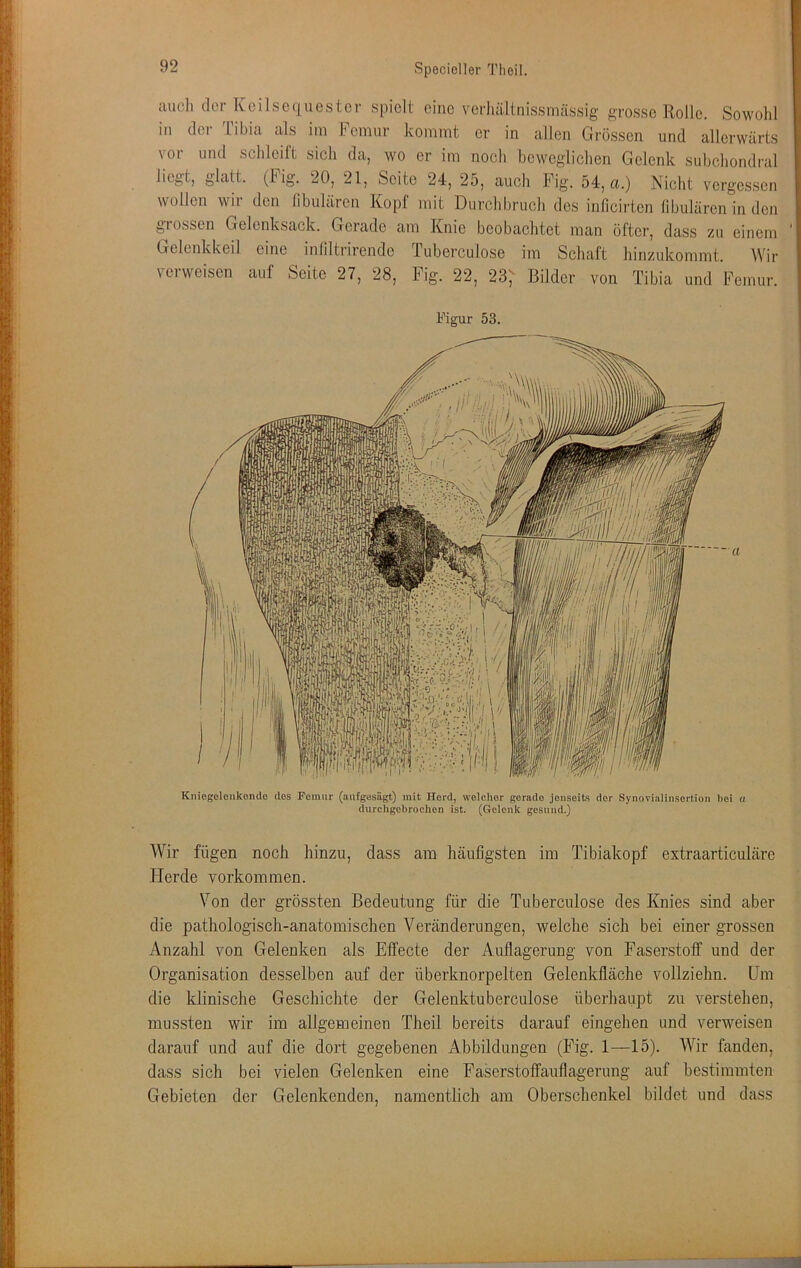 I t auch clci- Kcilscqucstcr spielt eine verliältnissmässig grosse Rolle. Sowohl in der Tibia als iin Femur kommt er in allen Grössen und allerwärts vor und schleift sich da, wo er im noch beweglichen Gelenk subchondral liegt, glatt. (Fig. 20, 21, Seite 24, 25, auch Fig. 54, a.) Nicht vergessen wollen wir den libulären Kopf mit Durchbrucli dos inficirten libulären in den grossen Gelonksack. Gerade am Knie beobachtet man öfter, dass zu einem Gelenkkeil eine iniiltrirende Tuberculose im Schaft hinzukommt. Wir verweisen auf Seite 27, 28, Fig. 22, 23;- Bilder von Tibia und Femur. Figur 53. Kniogelonkoiulo des romiir (aiifgesägt) mit Herd, welcher gerade jenseits der Synovialinsertion bei a durchgebrochon ist. (Gelenk gesund.) Wir fügen noch hinzu, dass am häufigsten im Tibiakopf extraarticuläre Herde verkommen. Von der grössten Bedeutung für die Tuberculose des Knies sind aber die pathologisch-anatomischen Veränderungen, welche sich bei einer grossen Anzahl von Gelenken als Effecte der Auflagerung von Faserstoff und der Organisation desselben auf der überknorpelten Gelenkfläche vollziehn. Um die klinische Geschichte der Gelenktuberculose überhaupt zu verstehen, mussten wir im allgemeinen Theil bereits darauf eingehen und verweisen darauf und auf die dort gegebenen Abbildungen (Fig. 1—15). Wir fanden, dass sich bei vielen Gelenken eine Faserstoffauflagerung auf bestimmten Gebieten der Gelenkenden, namentlich am Obersclienkel bildet und dass