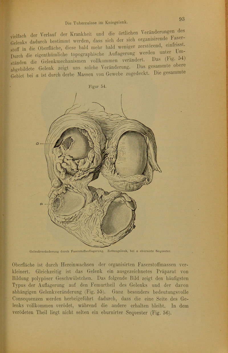 Die Tuberculose im Kniegelenk. vielfach der Verlauf der Krankheit und die örtlichen Veränderungen des Geleidvs dadurch bestimmt werden, dass sich der sich organisircrK c ^ aser stolT in die Oberfläche, diese bald mehr bald weniger zerstörend, cm nss. Durch die cigcnthümliche t9pographische yVuflagerung werden untei ^ m- ständen die Gclcnkmcchanismcn vollkommen verändert. Das ('ig- ^ abgebildcte Gelenk zeigt uns solche Veränderung. Das gesammte obere Gebiet bei a ist durch derbe Massen von Gewebe zugcdcckt. Die gesamm e Figur 54. GclcnkverniidorunR durch Fasorstoffauflagorung. Zottongeleuk, bei u cluirnirto Sequester. Oberfläche ist durch Hereinwachsen der organisirten Faserstofl’niassen ver- kleinert. Gleichzeitig ist das Gelenk ein ausgezeichnetes Präparat von Bildung polypöser Gcschwülstchen. Das folgende Bild zeigt den häuUgsten Typus der Auflagerung auf den Femurtheil des Gelenks und der davon abhängigen Gelenkveränderung (Fig. 55). Ganz besonders bedeutungsvolle Conseejuenzen werden herbeigeführt dadurch, dass die eine Seite des Ge- lenks vollkommen verödet, während die andere erhalten bleibt, ln dem verödeten Theil liegt nicht selten ein eburnirter Sequester (Fig. 56).