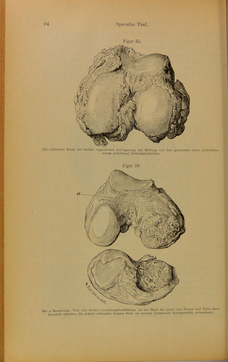 > Die vollendete Form der hereits organisirton Aunagerung mit Bildung von drei getrennten (zwei condylären, einem patcliaron) Gelonkabschnitten. Figur 55. Figur 56. Uei (I Beiiarbmig. Von den beiden Condylengelenkiliichen ist ein Theil der einen von Fennir und 'libia über- knorpelt erhalten, die seliwor erkrankte äussere Seite ist verödet (tiiberculös bindegewebig verwachsen).