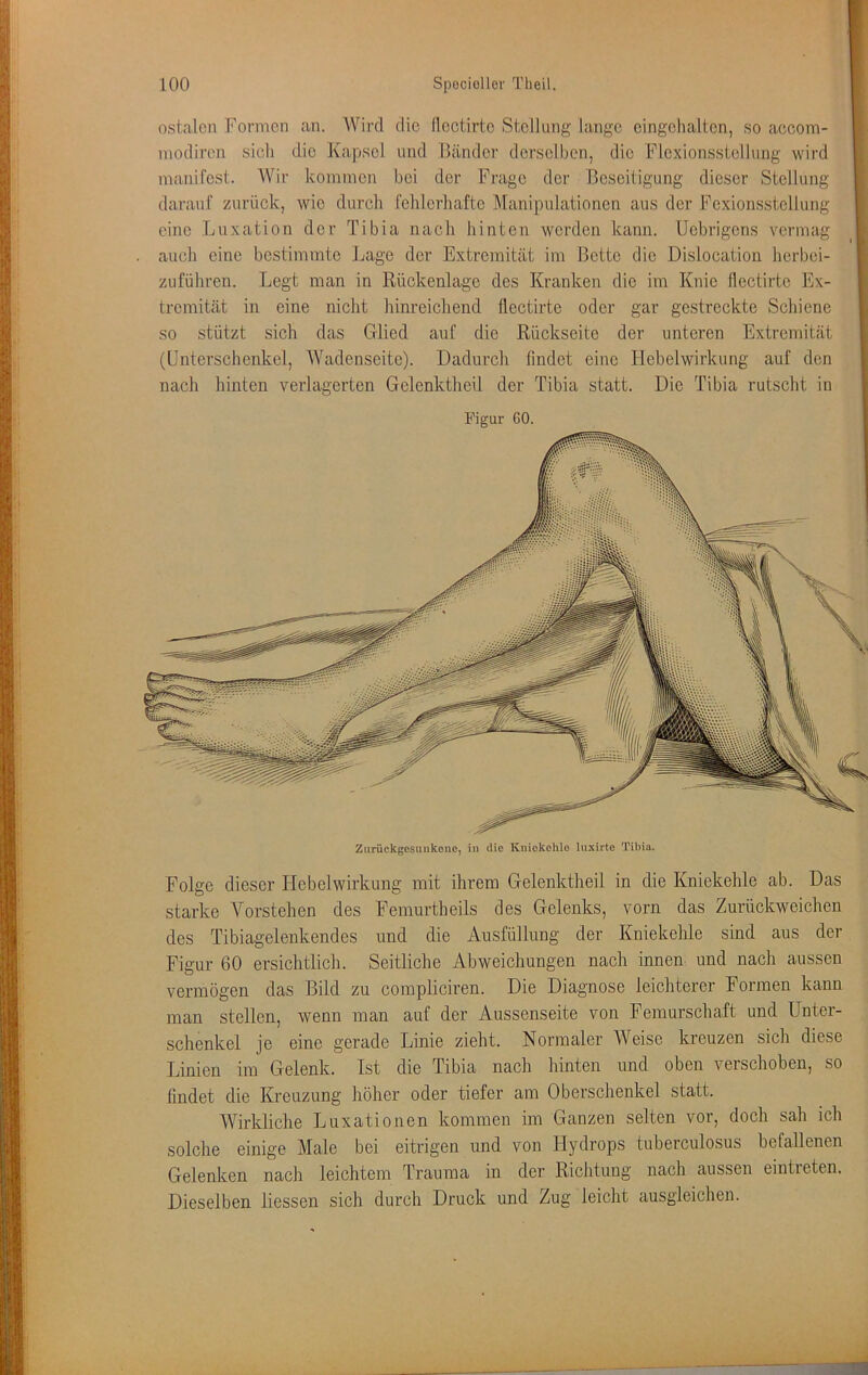ostalcn Formen an. Wird die (Icctirtc Stellung lange eingelialten, so aecom- inodireii sich die Kapsel und lländer derselben, die Flcxionssiclhing wird manifest. Wir kommen bei der Frage der Beseitigung dieser Stellung darauf zurück, wie durch fehlerhafte Manipulationen aus der Fexiorisstellung eine Luxation der Tibia nach hinten werden kann. Uebrigens vermag auch eine bestimmte Lage der Extremität im Bette die Dislocation herbei- zuführeu. Legt man in Rückenlage des Kranken die im Knie flectirtc Ex- tremität in eine nicht hinreichend flectirte oder gar gestreckte Schiene so stützt sich das Glied auf die Rückseite der unteren Extremität (Unterschenkel, Wadenseite). Dadurch findet eine Hebelwirkung auf den nach hinten verlagerten Gelenktheil der Tibia statt. Die Tibia rutscht in Figur 60. Zurückgcsuiikene, in die Kniekehle luxirte Tibia. Folge dieser Hebelwirkung mit ihrem Gelenktheil in die Kniekehle ab. Das starke Vorstehen des Femurtheils des Gelenks, vorn das Zurückweichen des Tibiagelenkendes und die Ausfüllung der Kniekehle sind aus der Figur 60 ersichtlich. Seitliche Abweichungen nach innen und nach aussen vermögen das Bild zu compliciren. Die Diagnose leichterer Formen kann man stellen, wenn man auf der Aussenseite von Femurschaft und Unter- schenkel je eine gerade Linie zieht. Normaler Weise kreuzen sich diese Linien im Gelenk. Ist die Tibia nach hinten und oben verschoben, so findet die Kreuzung höher oder tiefer am Oberschenkel statt. Wirkliche Luxationen kommen im Ganzen selten vor, doch sah ich solche einige Male bei eitrigen und von Hydrops tuberculosus befallenen Gelenken nach leichtem Trauma in der Richtung nach aussen eintreten. Dieselben Hessen sich durch Druck und Zug leicht ausgieichen.