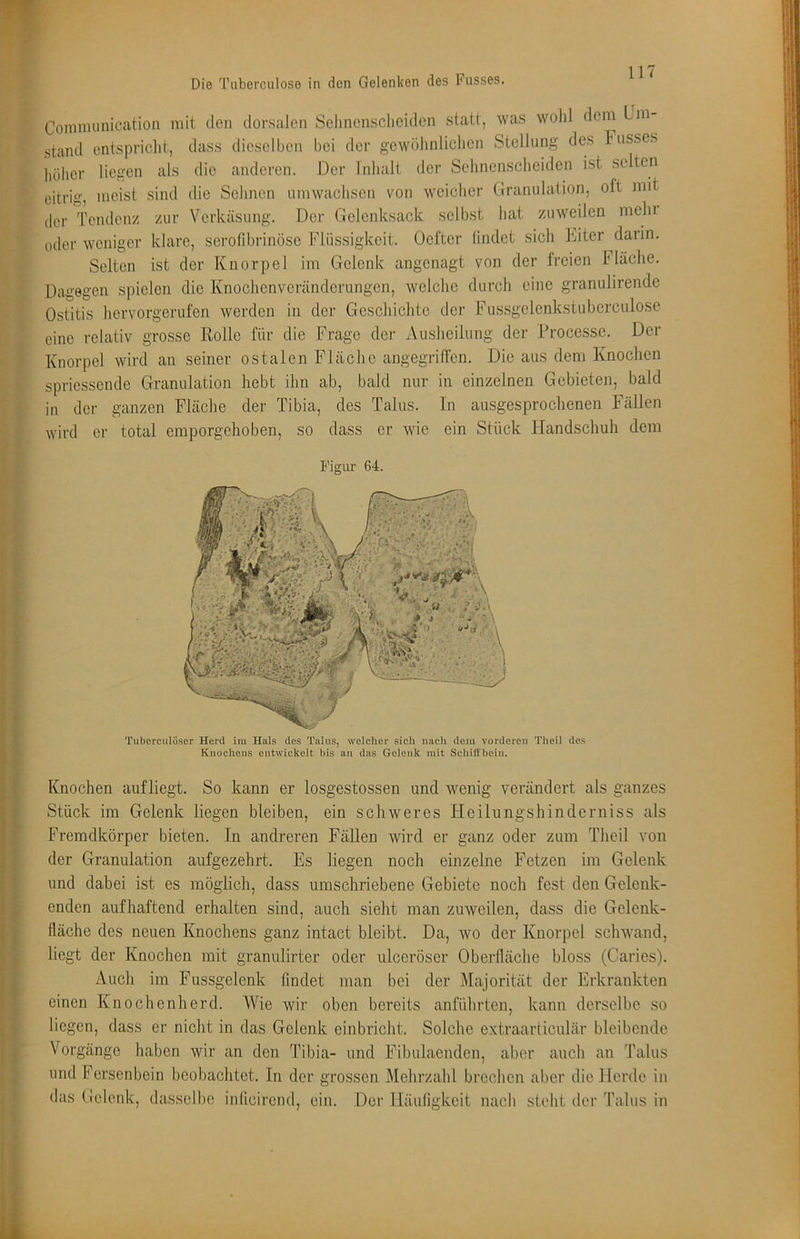 Commiinication mit den dorsalen Selmensclieidcn statt, was wohl dem m stand entspricht, dass dicsclhen bei der gewöhnlichen Stellung des luisses höher liegen als die anderen. Der lidialt der Sehnenscheiden ist selten eitrig, meist sind die Sehnen umwachsen von weicher Granulation, olt mit der Tendenz zur Verkäsung. Der Gelenksack selbst hat zuweilen mein oder weniger klare, serofihrinöse Flüssigkeit. Oefter (indet sich Fiter darin. Selten ist der Knorpel im Gelenk angenagt von der freien I'lache. Dagegen spielen die Knochenveränderungen, welche durch eine granulirende Ostitis hervorgerufen werden in der Geschichte der Fussgelenkstuberculose eine relativ grosse Rolle für die Frage der Ausheilung der Processe. Der Knorpel wird an seiner ostalen Fläche angegrilfen. Die aus dem Knochen spriessende Granulation hebt ihn ab, bald nur in einzelnen Gebieten, bald in der ganzen Fläche der Tibia, des Talus. In ausgesprochenen Fällen wird er total emporgehoben, so dass er wie ein Stück Handschuh dem Figur 64. Ttiberculöser Herd im Hals des TiiUis, welcher sich nach dem vorderen Theil de.s Knochens entwickelt bis an d.is Gelenk mit Scliiirbein. Knochen aufliegt. So kann er losgestossen und wenig verändert als ganzes Stück im Gelenk liegen bleiben, ein schweres Fleilungshinderniss als Fremdkörper bieten. In andreren Fällen wird er ganz oder zum Theil von der Granulation aufgezehrt. Es liegen noch einzelne Fetzen im Gelenk und dabei ist es möglich, dass umschriebene Gebiete noch fest den Gelenk- enden aufhaftend erhalten sind, auch sieht man zuweilen, dass die Gelenk- fläche des neuen Knochens ganz intact bleibt. Da, wo der Knorpel schwand, liegt der Knochen mit granulirter oder ulceröser Oberfläche bloss (Caries). Auch im Fussgelenk findet man bei der Majorität der Erkrankten einen Knochenherd. Wie wir oben bereits anführten, kann derselbe so liegen, dass er nicht in das Gelenk einbricht. Solche extraarticulär bleibende Vorgänge haben wir an den Tibia- und Fibulaenden, aber auch an Talus und Fersenbein beobachtet. In der grossen Mehrzahl brechen aber die Herde in das Gelenk, dasselbe inlicirend, ein. Der Häufigkeit nach stobt der Talus in