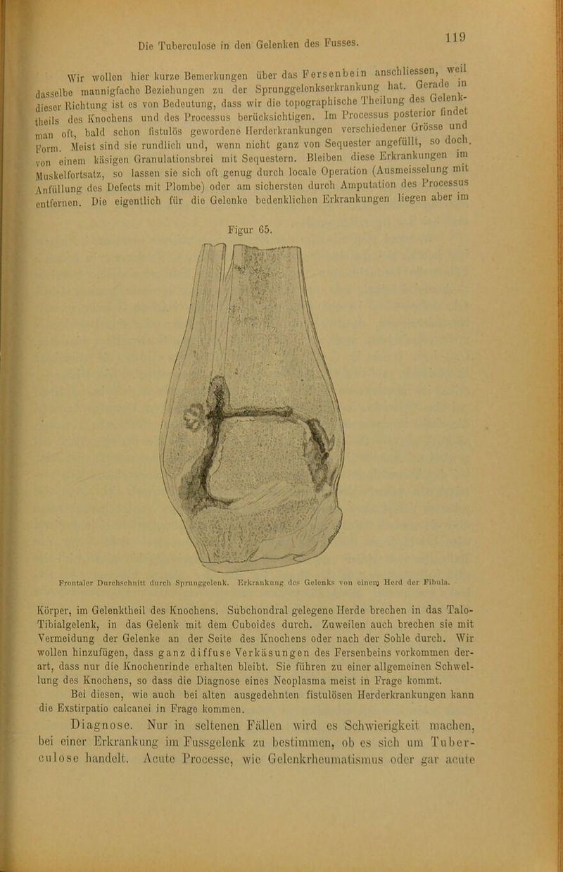 Wir wollen hier kurze Bemerkungen über das Fersenbein anschlie^en, ^ei dasselbe mannigfache Beziehungen zu der Sprunggelenkserkrankung hat. ® dieser Kichtung ist es von Bedeutung, dass wir die topographische Theilung des ® theils dos Knochens und dos Processus berücksichtigen. Im Processus postenor in e inan oft, bald schon fistulös gewordene Ilerderkrankungen verschiedener Grösse un Form. Meist sind sie rundlich und, wenn nicht ganz von Sequester angefüllt, so doci, von einem käsigen Granulationsbroi mit Sequestern. Bleiben diese Erkrankungen im Muskelforlsatz, so lassen sie sich oft genug durch locale Operation (Ausmeisselung mit Anfüllung des Defocts mit Plombe) oder am sichersten durch Amputation des Processus entfernen. Die eigentlich für die Gelenke bedenklichen Erkrankungen liegen aber im Körper, im Gelenktheil des Knochens. Subchondral gelegene Herde brechen in das Talo- Tibialgelenk, in das Gelenk mit dem Cuboides durch. Zuweilen auch brechen sie mit Vermeidung der Gelenke an der Seite des Knochens oder nach der Sohle durch. Wir wollen hinzufügen, dass ganz diffuse Verkäsungen des Fersenbeins Vorkommen der- art, dass nur die Knochenrinde erhalten bleibt. Sie führen zu einer allgemeinen Schwel- lung des Knochens, so dass die Diagnose eines Neoplasma meist in Frage kommt. Bei diesen, wie auch bei alten ausgedehnten fistulösen Herderkrankungen kann die Exstirpatio calcanei in Frage kommen. Diagnose. Nur in seltenen Fällen Avird es Sclnvierigkeit inaclien, bei einer Erkrankung im Fussgelenk zu bestimmen, ob cs sich um Tuber- culose handelt. Acute Processc, wie Gelenkrheumatismus oder gar acule
