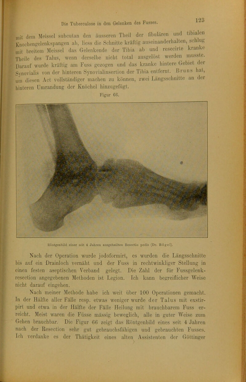 Die Tuberculose in den Gelenken des Pusses. mit dem Meisscl siibcutan den äusseren Tlieil der fibulären und tibialen luiocliengclenksnangen ab, liess die Sclinitte kräftig auscinanderbalten, scli Uf, IvnocliengclenKspangi mit breitem Äleissel das Gelenkende der Theile des Talus, wenn derselbe nicht Tibia total ab und resecirte kranke ausgelöst werden musste. Darauf wurde kräftig am Fuss gezogen und das kranke hintere Gebiet dei Synovialis von der hinteren Synovialinsertion der Tibia entlernt. Bruns bat, um diesen Act vollständiger machen zu können, zwei Jmngsschnitte an der hinteren Umrandung der Knöchel hinzugefiigt. Figur 66. Uöntgonbild einer seit 4 Jahren ausgoheilten Uesoctio pedis (Dr. Bögcl). Nach der Operation wurde jodoformirt, es wurden die Längsschnitte bis auf ein Drainlocli vernäht und der Fuss in rechtwinkliger Stellung in einen festen aseptischen Verband gelegt. Die Zahl der für Fussgelenk- resection angegebenen Methoden ist Legion. Ich kann begreilliclier Weise nicht darauf eingehen. Nach meiner Methode habe ich weit über 100 Operationen gemacht. In der Hälfte aller Fälle resp. etwas weniger wurde der Talus mit exstir- pirt und etwa in der Hälfte der Fälle Heilung mit brauchbarem Fuss er- reicht. Meist waren die Füsse mässig beweglich, alle in guter AVeisc zum Gehen brauchbar. Die Figur 66 zeigt das Röntgenbild eines seit 4 Jahren nach der Resection sehr gut gebrauchsfähigen und gebrauchten Fusses. Ich verdanke es der Thätigkeit eines alten Assistenten der Göttinger