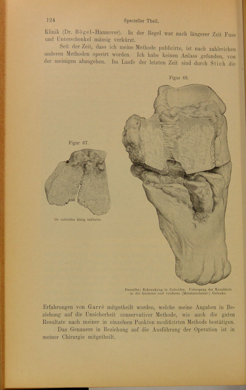 Klinik (Dr. Bögel-Hannover). In der Kegel war nacli längerer Zeit Fu.ss und IJnteraohenkel mässig verkürzt. Seit der Zeit, dass ich meine Methode publicirte, ist nach zahlreichen anderen Methoden operirt worden. Ich habe keinen Anlass gefunden, von der nieinigen abzugehen. Im Laufe der letzten Zeit sind durch Stich die Figur 68. Figur 67. On eiiboidos käsig intiltrirt. Dasselbe; Erkrankung in Ciiboidos. Uebergang der Krankheit in die hinteren und vorderen (Metutarsotarsal-) Gelenke. Erfahrungen von Garre mitgetheilt worden, weiche meine Angaben in Be- ziehung auf die Unsicherheit conservativer Methode, wie auch die guten Resultate nach meiner in einzelnen Punkten modilicirten Methode bestätigen. Das Genauere in Beziehung auf die Ausführung der Operation ist in meiner Chirurgie mitgetheilt.