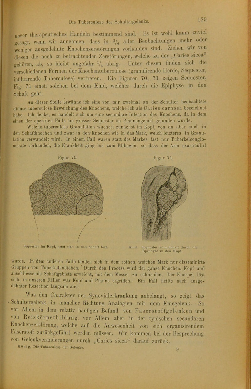 Die Tuborculose dos Schultergelenks. unser tlicrapcutisclics Handeln bestimmend sind. Es ist wohl kaum zuviel gesagt, wenn wir annclimen, dass in % Beobachtungen mehr oder weniger ausgedehnte Knochenzerstörungen vorlianden sind. Zielien wir von diesen die noch zu betraclitenden Zerstörungen, welche zu der „Caries sicca“ gehören, ab, so bleibt ungefähr Y4 übrig. Unter diesen finden sich die verschiedenen Formen der Knochentuberculose (granulirende Herde, Sequester, infiltrirende Tuberculose) vertreten. Die Figuren 70, 71 zeigen Sequester, Fig. 71 eineü solchen bei dem Kind, welcher durch die Epiphyse in den Schaft geht. An dieser Stelle erwähne ich eine von mir zweimal an der Schulter beobachtete dill’use tuberculose Erweichung des Knochens, welche ich als Caries carnosa bezeichnet habe. Ich denke, es handelt sich um eine secundäro Tnfection des Knochens, da in dem einen der operirten Fälle ein grosser Sequester im Pfannengebiet gefunden wurde. Weiche tuberculose Granulation wuchert zunächst im Kopf, von da aber auch in den Schaftknochen und zwar in den Knochen wie in das Mark, welch letzteres in Granu- lation verwandelt wird. In einem Fall waren statt dos Markes fast nur Tuberkelconglo- merate vorhanden, die Krankheit ging bis zum Ellbogen, so dass der Arm exarticulirt Figur 70. Soiiußstor im Kopf, setzt sich in den Schuft fort. Figur 71. Kind. Sequester vom Schaft durch die Epiphyse in den Kopf. wurde. In dem anderen Falle fanden sich in dem rotlien, weichen Mark nur disseminirte Gruppen von Tuberkelknötchen.' Durch den Process wird der ganze Knochen, Kopf und anschliessende Schaftgebiete erweicht, mit dem Messer zu schneiden. Der Knorpel löst sich, in unseren Fällen war Kopf und Pfanne ergriffen. Ein Fall heilte nach ausge- dehnter Resection langsam aus. Was den Charakter der Synovialerkrankung anbelangt, so zeigt das Schultergelenk in mancher Richtung Analogien mit dem Kniegelenk. So vor Allem in dem relativ häufigen Befund von Faserstoffgclenken und von Reiskörpcrbildung, vor Allem aber in der typischen secundären Knochenzerstörung, welche auf die Anwesenheit von sich organisirendem Faserstoff zuriiekgeführt werden müssen. AVir kommen bei der Besprechung von Gclenkvcrändcruugen durch „Caries sicca“ darauf zurück. König, Die Tuberculose der Gelenke. 9