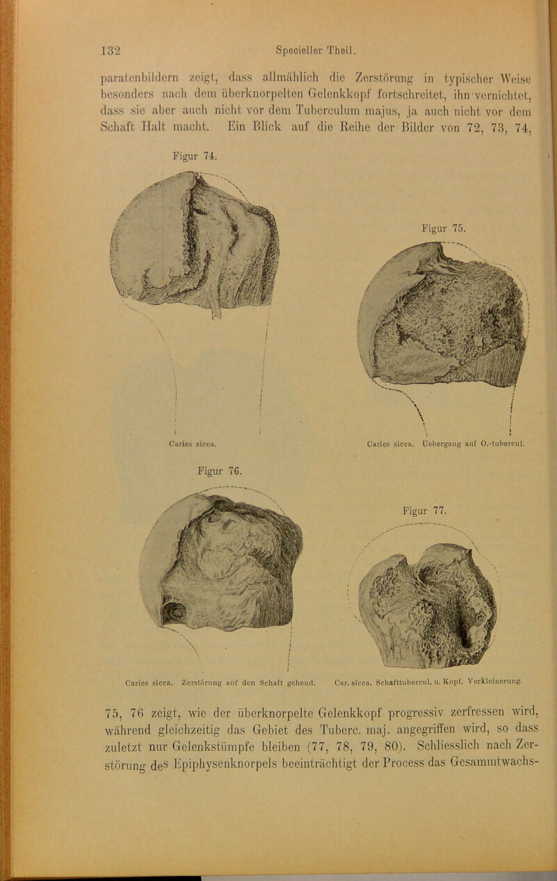 paratcnbiklcrn zcigl, dass allmählich die Zerstönmg in typischer Weise besonders nach dem iiberknorpeiten Gclenkkopf fortschreitet, ihn vernichtet, dass sie aber auch nicht vor dem Tuberculum majus, ja auch nicht vor dem Schaft Halt macht. Ein Blick auf die Reihe der Bilder von 72, 73, 74, Figur 74. Figur 75. I Carios sicca. I J I { I I Figur 76. Caries sicca, ücborgang auf O.-tubercul. Figur 77. Car. sicca. Schafttubercul. u. Kopf. A'orkleinerung. Carios sicca. Zerstörung auf den Schaft gehend. 75, 76 zeigt, wie der überknorpelte Gelenkkopf progressiv zerfressen wird, während gleichzeitig das Gebiet des Tuberc. maj. angegriffen wird, so dass zuletzt nur Gelenkstümpfe bleiben (77, 78, 79, 80). Schliesslich nach Zer- störung deS hipiphysenknorpels beeinträchtigt der Process das Gcsamratwachs-