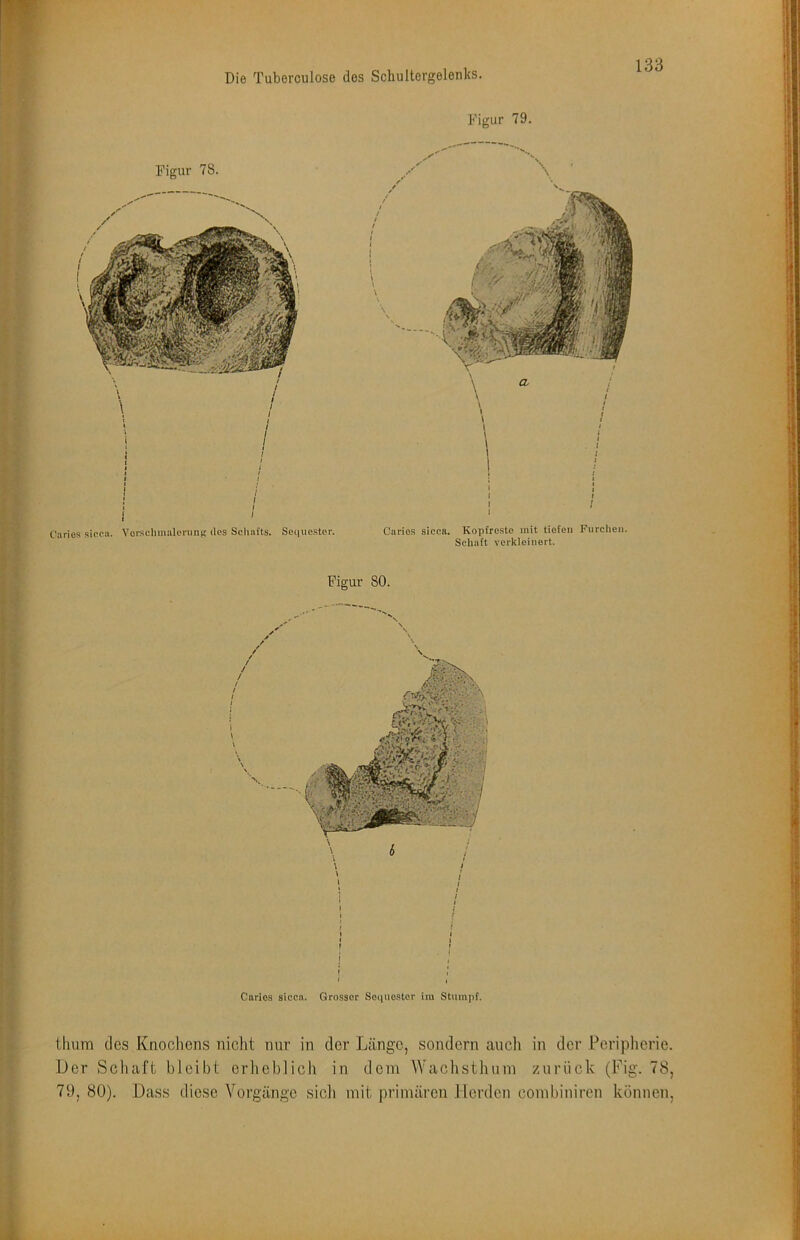 Figur 79. Figur 78. C'arios siccii. VorsclimalenuiK lies Schafts. Sei|iioster. Caries sicca. Kopfresto mit tiefen Furchen. Schaft verkleinert. Figur 80. Caries sicca. Grosser Soqnostor im Stumpf. tlium des Knochens nicht nur in der Länge, sondern auch in der Peripherie. Der Schaft bJeibt erheblich in dem Wachsthnni zurück (Fig. 78, 79, 80). Dass diese Vorgänge sicli mit primären Herden combiniren können.