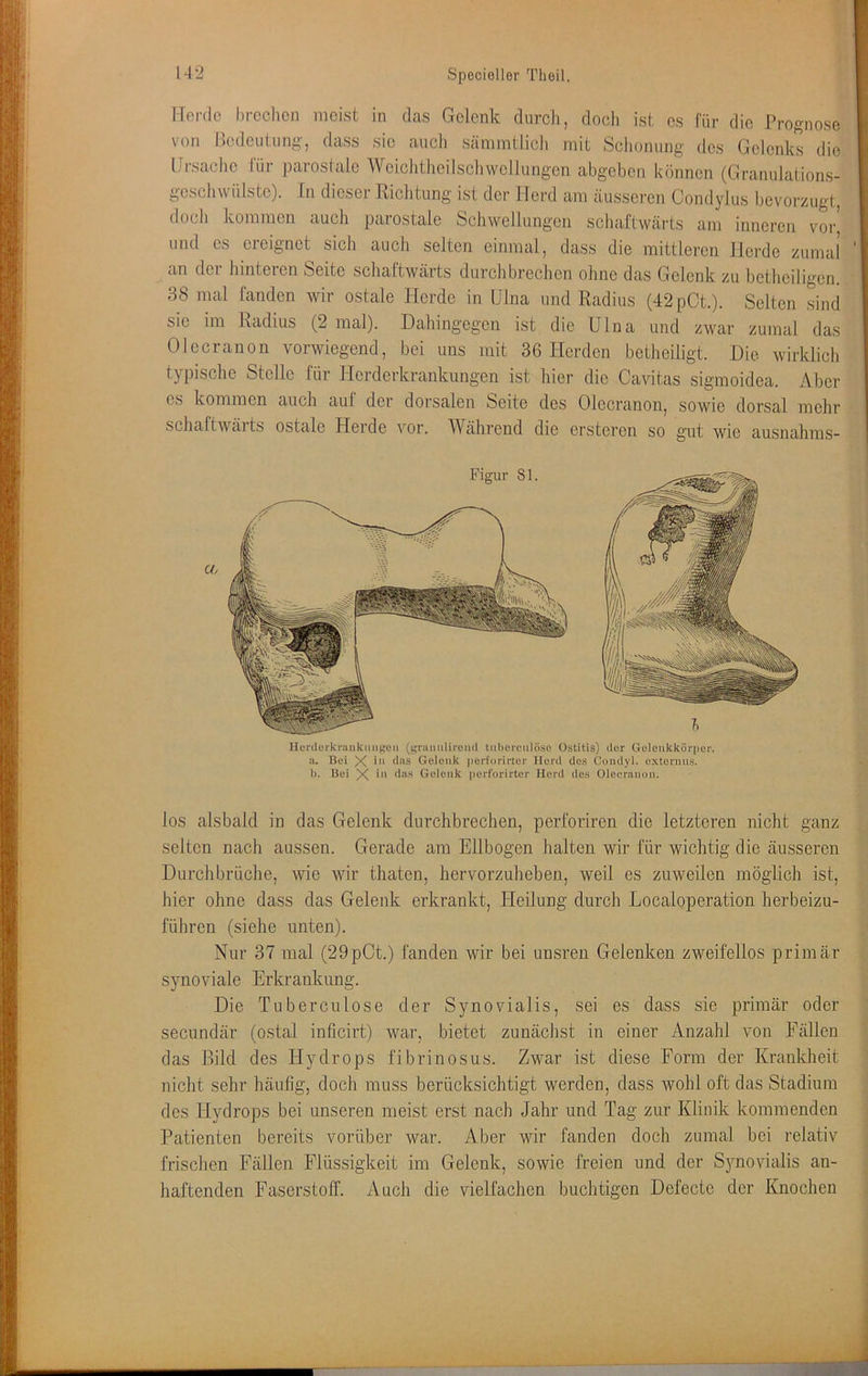 Morde hrcchen meist in das Gelenk durcli, doch ist cs für die Prognose von Bedeutung, dass sie aucli sämmtlich mit Schonung des Gelenks die Mrsaclic lur parostale Wciclithcilscliwollungen abgeben können (Granulations- gcschwiilstc). In dieser Riclitimg ist der Herd am äusseren Condylus bevorzugt, docli kommen auch parostale Schwellungen schaftwärts am inneren vor’ und es ereignet sich auch selten einmal, dass die mittleren Herde zumal an der hinteren Seite schaftwärts durchbrechen ohne das Gelenk zu betheiligen. 38 mal fanden wir ostale Herde in Ulna und Radius (42pCt.). Selten sind sie im Radius (2 mal). Dahingegen ist die Ulna und zwar zumal das Olccranon vorwiegend, bei uns mit 36 Herden betheiligt. Die wirklich typische Stelle für Herderkrankungen ist hier die Cavitas sigmoidea. Aber cs kommen auch auf der dorsalen Seite des Olccranon, sowie dorsal mehr schaftwärts ostale Herde vor. Während die erstcren so gut wie ausnahms- Figur 81. 7. Hcnlorkranknn^cii ({;ramiUreiul tubcrcnlÖso Ostitis) der GelciikkÖrpci*. a. Bei X Gelenk perforirtor Herd des Condyl. oxtonius. l). Bei X Gelenk perforirtor Herd des Olecranon. los alsbald in das Gelenk durchbrechen, perforiren die letzteren nicht ganz selten nach aussen. Gerade am Ellbogen halten wir für wichtig die äusseren Durchbrüche, wie wir thaten, hervorzuheben, weil es zuweilen möglich ist, hier ohne dass das Gelenk erkrankt, Pleilung durch Localoperation herbeizu- führen (siehe unten). Nur 37 mal (29pCt.) fanden wir bei unsren Gelenken zweifellos primär synoviale Erkrankung. Die Tuberculose der Synovialis, sei es dass sie primär oder secundär (ostal inficirt) Avar, bietet zunächst in einer Anzahl von Fällen das Bild des Plydrops fibrinosus. Zwar ist diese Form der Krankheit nicht sehr häufig, doch muss berücksichtigt werden, dass wohl oft das Stadium des Hydrops bei unseren meist erst nach Jahr und Tag zur Klinik kommenden Patienten bereits vorüber war. Aber wir fanden doch zumal bei relativ frischen Fällen Flüssigkeit im Gelenk, sowie freien und der Sjmovialis an- haftenden Faserstoff. Auch die vielfachen buchtigen Defectc der Knochen