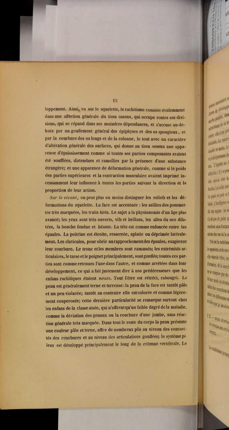 loppement. Ainsi, vu sur le squelette, le rachitisme consiste évidemment dans une affection générale du tissu osseux, qui occupe toutes ses divi- sions, qui se répand dans ses moindres dépendances, et s’accuse au-de- hors par un gonflement général des épiphyses et des os spongieux, et par la courbure des os longs et de la colonne, le tout avec un caractère d’altération générale des surfaces, qui donne au tissu osseux une appa- rence d’épaississement comme si toutes ses parties composantes avaient été soufflées, distendues et ramollies par la présence d’une substance étrangère; et une apparence de déformation générale, comme si le poids des parties supérieures et la contraction musculaire avaient imprimé in- cessamment leur influence à toutes les parties suivant la direction et la proportion de leur action. Sur le vivant, on peut plus ou moins distinguer les reliefs et les dé- formations du squelette. La face est accentuée : les saillies des pommet- tes très marquées, les traits tirés. Le sujet a la physionomie d’un âge plus avancé; les yeux sont très ouverts, vifs et brillans, les ailes du nez dila- tées, la bouche fendue et béante. La tête est comme enfoncée entre les épaules. La poitrine est étroite, resserrée, aplatie ou déprimée latérale- ment. Les clavicules, pour obéir aurapprochementdes épaules, exagèrent leur courbure. Le tronc et les membres sont ramassés; les extrémités ar- ticulaires, le tarse et le poignet principalement, sont gonflés; toutes ces par- ties sont comme retenues l’une dans l’autre, et comme arrêtées dans leur développement, ce qui a fait justement dire à nos prédécesseurs que les enfans rachitiques étaient noués. Tout l’être est rétréci, rabougri. La peau est généralement terne et terreuse : la peau de la face est tantôt pâle et un peu violacée; tantôt au contraire elle est colorée et comme légère- ment couperosée; cette dernière particularité se remarque surtout chez les enfans delà classe aisée, qui n’offrent qu’un faible degré de la maladie, comme la déviation des genoux ou la courbure d’une jambe, sans réac- tion générale très marquée. Dans tout le reste du corps la peau présente une couleur pâle et terne, offre de nombreux plis au niveau des concavi- tés des courbures et au niveau des articulations gonflées; le système pi leux est développé principalement le long de la colonne vertébrale. Le