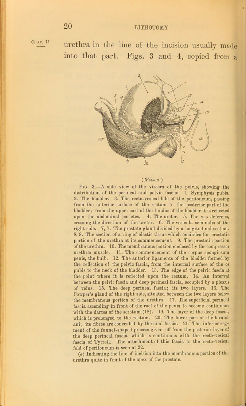 urethra in the line of the incision usually made into that part. Figs. 3 and 4, copied from a distribution of the perineal and pelvic faaoise. 1. Symphysis pubis. 2. The bladder. 3. The recto-vesical fold of the peritoneum, passing from the anterior surface of the rectum to the posterior part of the bladder; from the upper part of the fundus of the bladder it is reflected upon the abdominal parietes. 4. The ureter. 5. The vas deferens, crossing the direction of the ureter. 6. The vesicula seminalis of the right side. 7, 7. The prostate gland divided by a longitudinal section. 8, 8. The section of a ring of elastic tissue which encircles the prostatic portion of the urethra at its commencement. 9. The prostatic portion of the urethra. 10. The membranous portion enclosed by the compressor urethrae muscle. 11. The commencement of the corpus spongios\im penis, the bulb. 12. The anterior ligaments of the bladder formed by the reflection of the pelvic fascia, from the internal surface of the os pubis to the neck of the bladder. 13. The edge of the pelvic fascia at the point where it is reflected upon the rectum. 14. An interval between the pelvic fascia and deep perineal fascia, occupied by a plexus of veins. 15. The deep perineal fascia; its two layers. 16. The Cowper’s gland of the right side, situated between the two layers below the membranous portion of the urethra. 17. The superficial perineal fascia ascending in front of the root of the penis to become continuous with the dartos of the scrotum (18). 19. The layer of the deep fascia, which is prolonged to the rectum. 20. The lower part of the levator ani; its fibres are concealed by the anal fascia. 21. The inferior seg- ment of the funnel-shaped process given OS' from the posterior layer of the deep perineal fascia, which is continuous with the recto-vesical fascia of Tyrrell. The attachment of this fascia to the recto-vesical fold of peritoneum is seen at 22. (a) Indicating the line of incision into the membranous portion of the urethra quite in front of the apex of the prostate.