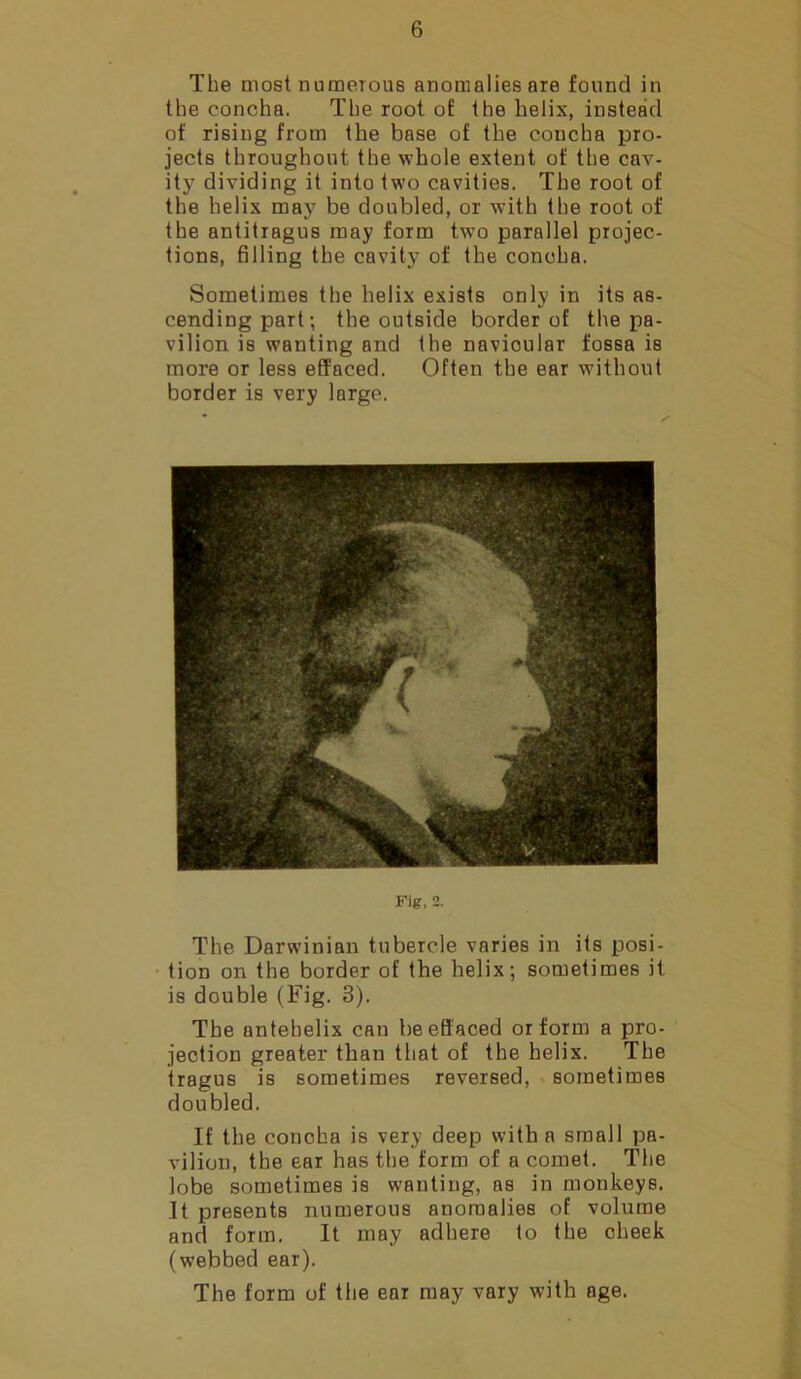 The most numerous anomalies are found in the concha. The root of the helix, instead of rising from the base of the concha pro- jects throughout the whole extent of the cav- ity dividing it into two cavities. The root of the helix may be doubled, or with the root of the antitragus may form two parallel projec- tions, filling the cavity of the concha. Sometimes the helix exists only in its as- cending part; the outside border of the pa- vilion is wanting and the navicular fossa is more or less effaced. Often the ear without border is very large. Fig, 2. The Darwinian tubercle varies in its posi- tion on the border of the helix; sometimes it is double (Fig. 3). The antehelix can beeffaced or form a pro- jection greater than that of the helix. The tragus is sometimes reversed, sometimes doubled. If the concha is very deep with a small pa- vilion, the ear has the form of a comet. The lobe sometimes is wanting, as in monkeys. It presents numerous anomalies of volume and form. It may adhere to the cheek (webbed ear). The form of the ear may vary with age.