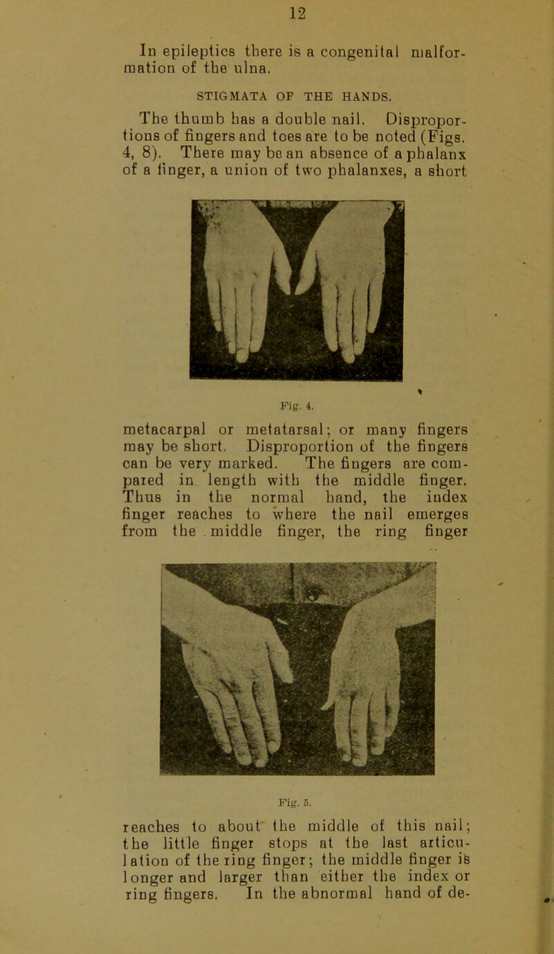 In epileptics there is a congenital malfor- mation of the ulna. STIGMATA OF THE HANDS. The thumb has a double nail. Dispropor- tions of fingers and toes are to be noted (Figs. 4, 8). There may bean absence of a phalanx of a finger, a union of two phalanxes, a short Fig. 4. metacarpal or metatarsal; or many fingers may be short. Disproportion of the fingers can be very marked. The fingers are com- pared in length with the middle finger. Thus in the normal hand, the index finger reaches to where the nail emerges from the middle finger, the ring finger Fig. 5. reaches to about the middle of this nail; the little finger stops at the last articu- lation of the ring finger; the middle finger is longer and larger than either the index or ring fingers, In the abnormal hand of de-