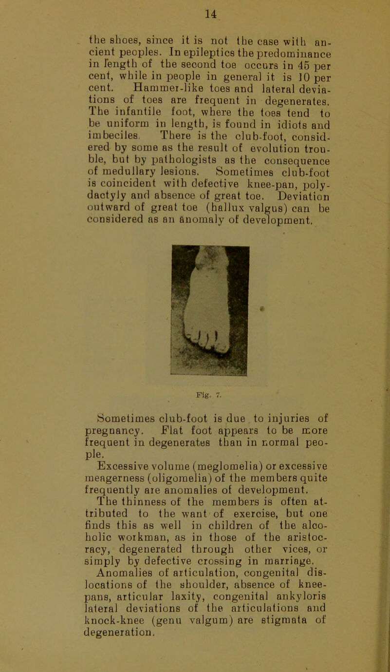 the shoes, since it is not the case with an- cient peoples. In epileptics the predominance in length of the second toe occurs in 45 per cent, while in people in genera] it is 10 per cent. Hanuner-like toes and lateral devia- tions of toes are frequent in degenerates. The infantile foot, where the toes tend to be uniform in length, is found in idiots and imbeciles, There is the club-foot, consid- ered by some as the result of evolution trou- ble, but by pathologists as the consequence of medullary lesions. Sometimes club-foot is coincident with defeotive knee-pan, poly- dactyly and absence of great toe. Deviation outward of great toe (hallux valgus) can be considered ns an anomaly of development. Fig. 7. Sometimes club-foot is due to injuries of pregnancy. Flat foot appears to be more frequent in degenerates than in normal peo- ple. Excessive volume (meglomelia) or excessive meagerness (oligomelia) of the members quite frequently are anomalies of development. The thinness of the members is often at- tributed to the want of exeroise, but one finds this as well in children of the aloo- holic workman, as in those of the aristoc- racy, degenerated through other vices, or simply by defective crossing in marriage. Anomalies of articulation, congenital dis- locations of the shoulder, absence of knee- pans, articular laxity, congenital nnkyloris lateral deviations of the articulations and knock-knee (genu valgum) are stigmata of degeneration,