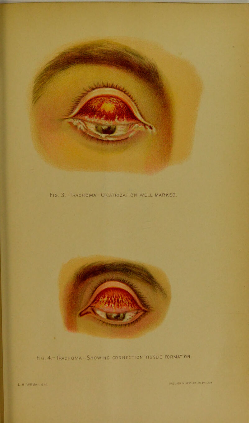 Fig. 3.-Trachoma-Ocatrization well marked. Fig. 4-.-Trachoma-Showing connection tissue formation. L H Wilder dft- PHElHtR ,1 KlSSlER CO.PHILAO*