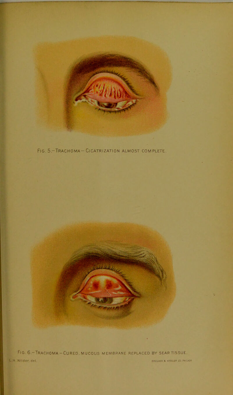 Fig. 6,-Trachoma-Cured, MUCOUS membrane replaced by sear tissue.