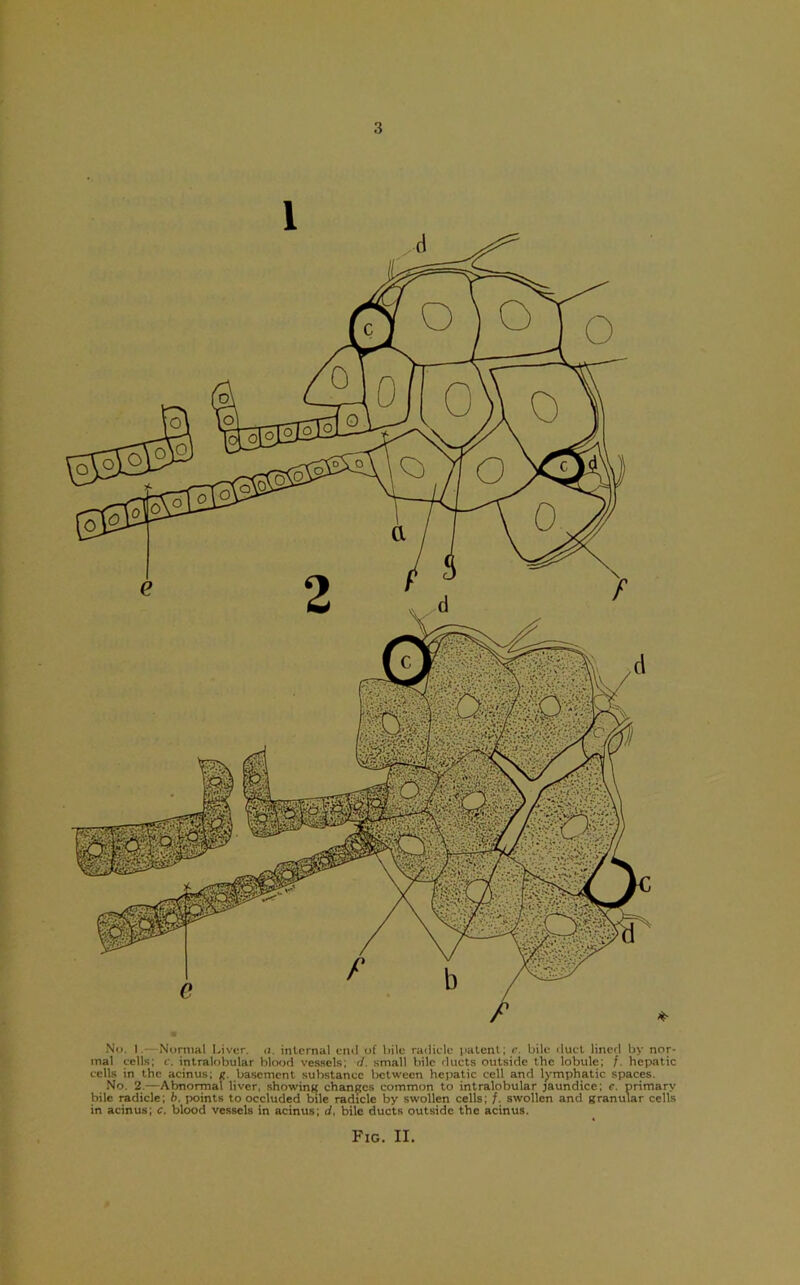 No. I. Normal Liver, a. iiiLcrnal einl of liilc railiclc palenl; r. bile ilucl lined by nor- mal cells; c. intralobular blood vessels; (/. small Irile ducts outside the lobule; f. hepatic cells in the acinus; g. basement substance between hepatic cell and lymphatic spaces. No. 2.—Abnormal liver, showinK chanecs common to intralobular jaundice; c. primary bile radicle; b. points to occluded bile radicle by swollen cells; /. swollen and granular cells in acinus; c. blood vessels in acinus; d, bile ducts outside the acinus. Fig. II.