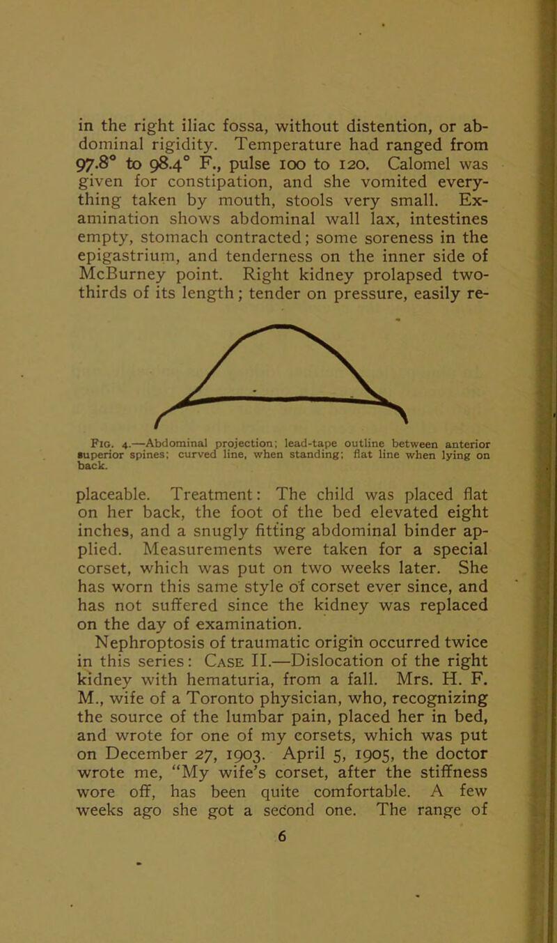 in the right iliac fossa, without distention, or ab- dominal rigidity. Temperature had ranged from 97-8° to 98.4° F., pulse 100 to 120. Calomel was given for constipation, and she vomited every- thing taken by mouth, stools very small. Ex- amination shows abdominal wall lax, intestines empty, stomach contracted; some soreness in the epigastrium, and tenderness on the inner side of McBurney point. Right kidney prolapsed two- thirds of its length; tender on pressure, easily re- Fig. 4.—Abdominal projection; lead-tape outline between anterior superior spines; curved line, when standing; flat line when lying on back. placeable. Treatment: The child was placed flat on her back, the foot of the bed elevated eight inches, and a snugly fitting abdominal binder ap- plied. Measurements were taken for a special corset, which was put on two weeks later. She has worn this same style of corset ever since, and has not suffered since the kidney was replaced on the day of examination. Nephroptosis of traumatic origin occurred twice in this series: Case II.—Dislocation of the right kidney with hematuria, from a fall. Mrs. H. F. M., wife of a Toronto physician, who, recognizing the source of the lumbar pain, placed her in bed, and wrote for one of my corsets, which was put on December 27, 1903. April 5, 1905, the doctor wrote me, “My wife’s corset, after the stiffness wore off, has been quite comfortable. A few weeks ago she got a second one. The range of