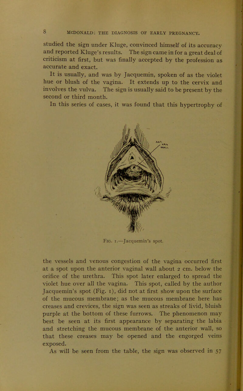 studied the sign under Kluge, convinced himself of its accuracy and reported Kluge’s results. The sign came in for a great deal of criticism at first, but was finally accepted by the profession as accurate and exact. It is usually, and was by Jacquemin, spoken of as the violet hue or blush of the vagina. It extends up to the cervix and involves the vulva. The sign is usually said to be present by the second or third month. In this series of cases, it was found that this hypertrophy of Fig. i.—Jacquemin’s spot. the vessels and venous congestion of the vagina occurred first at a spot upon the anterior vaginal wall about 2 cm. below the orifice of the urethra. This spot later enlarged to spread the violet hue over all the vagina. This spot, called by the author Jacquemin’s spot (Fig. 1), did not at first show upon the surface of the mucous membrane; as the mucous membrane here has creases and crevices, the sign was seen as streaks of livid, bluish purple at the bottom of these furrows. The phenomenon may best be seen at its first appearance by separating the labia and stretching the mucous membrane of the anterior wall, so that these creases may be opened and the engorged veins exposed. As will be seen from the table, the sign was observed in 57