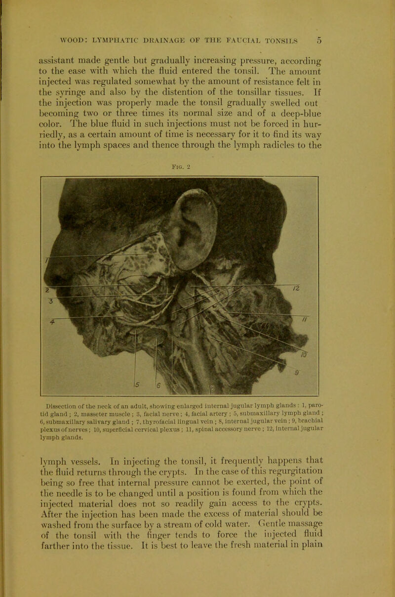 assistant made gentle but gradually increasing pressure, according to the ease with which the fluid entered the tonsil. The amount injected was regulated somewhat by the amount of resistance felt in the syringe and also by the distention of the tonsillar tissues. If the injection was properly made the tonsil gradually swelled out becoming two or three times its normal size and of a deep-blue color. The blue fluid in such injections must not be forced in hur- riedly, as a certain amount of time is necessary for it to find its way into the lymph spaces and thence through the lymph radicles to the Fig. 2 Dissection of the neck of an adult, showing enlarged internal jugular lymph glands : 1, paro- tid glaud ; 2, masseter muscle ; 3, facial nerve ; 4, facial artery ; 5, submaxillary lymph gland ; 6, submaxillary salivary gland ; 7, tbyrofacial lingual vein ; 8, internal jugular vein ; 9, brachial plexus of nerves; 10, superficial cervical plexus ; 11, spinal accessory nerve ; 12, internal jugular lymph glands. lymph vessels. In injecting the tonsil, it frequently happens that the fluid returns through the crypts. In the case of this regurgitation being so free that internal pressure cannot be exerted, the point of the needle is to be changed until a position is found from which the injected material does not so readily gain access to the crypts. After the injection has been made the excess of material should be washed from the surface by a stream of cold water. Gentle massage of the tonsil with the finger tends to force the injected fluid farther into the tissue. It is best to leave the fresh material in plain