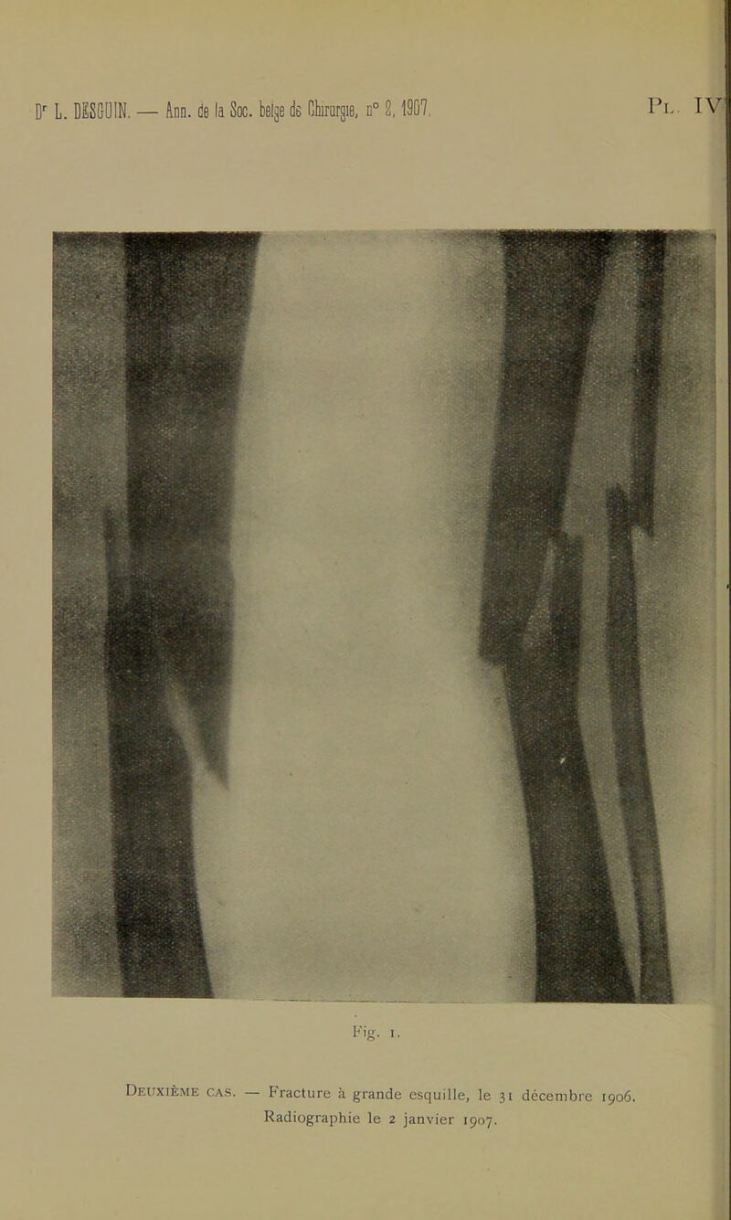 Kig. i. Deuxième cas Fracture à grande esquille, le 31 décembre 1906 Radiographie le 2 janvier 1907.