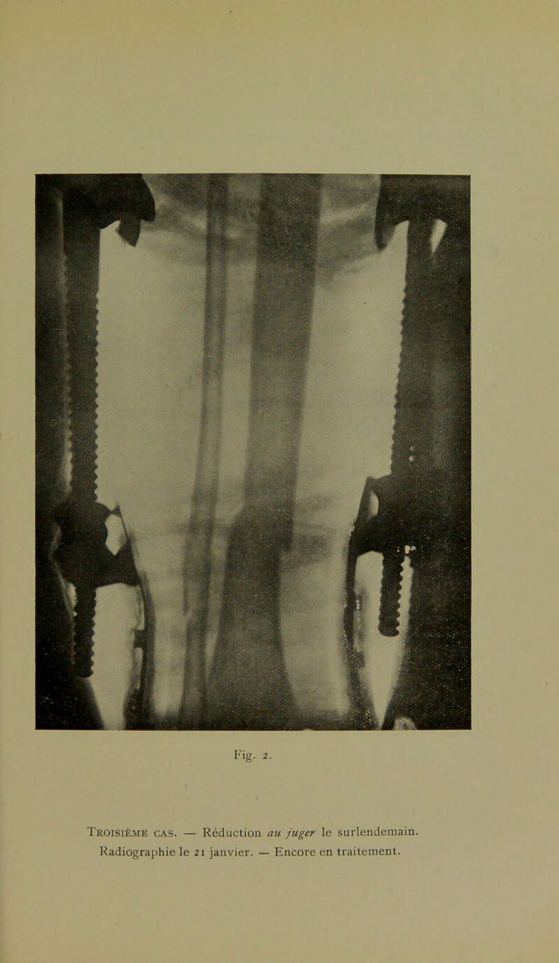 Troisième cas. — Réduction au juger le surlendemain. Radiographie le 21 janvier. — Encore en traitement. l.ïf