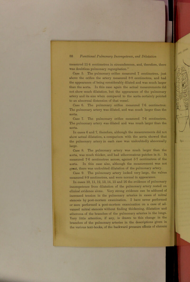 measured 11'4 centimetres in ou’cumference, and, therefore, there was doubtless pulmonary regurgitation.” Case 5. The pulmonary orifice measured 7 centimetres, just above the orifice the artery measured 8-8 centimetres, and had the appearance of being considerably dilated and was much larger than the aorta. In this case again the actual measurements did not show much dilatation, but the appearance of the pulmonary artery and its size when compared to the aorta certainly pointed to an abnormal distension of that vessel. Case 6. The pulmonary orifice measured 7'6 centimetres. The pulmonary artery was dilated, and was much larger than the aorta. Case 7. The pulmonary orifice measured 7'6 centimetres. The pulmonary ax'tery was dilated and was much larger than the aorta. In cases 6 and 7, therefore, although the measurements did not show actual dilatation, a comparison with the aorta showed that the pulmonary artery in each case was undoubtedly abnormally large. Case 8. The pulmonary artery was much larger than the aorta, was much thicker, and had atheromatous patches in it. It measured 7'6 centimetres across, against 5'7 centimetres of the aorta. In this case also, although the measurement was not great, there was undoubted dilatation of the pulmonary artery. Case 9. The pulmonary artery looked very large, the valves measured 8-9 centimetres, and were normal in appearance. In cases 10, 11,12, 13,14, 15 and 16 the evidence of pulmonary incompetence from dilatation of the pulmonary artery rested on clinical evidence alone. Very strong evidence can be adduced of increased tension in the pulmonary arteries in cases of mitral stenosis by post-mortem examination. I have never performed or seen performed a post-mortem examination on a case of ad- vanced mitral stenosis without finding thickening, dilatation and atheroma of the branches of the pulmonary arteries in the lungs. Very little attention, if any, is drawn to this change in the branches of the pulmonary arteries in the descriptions given in the various text-books, of the backward px'essure effects of chronic