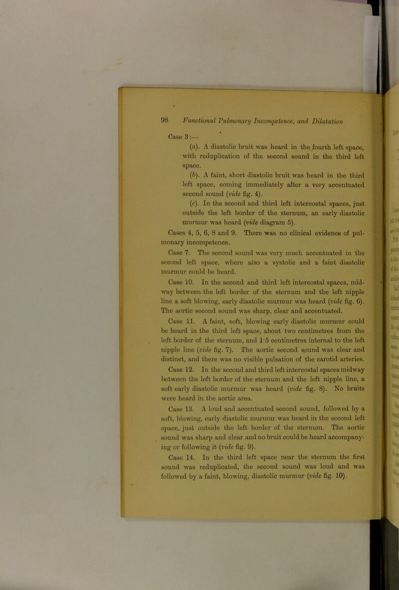 Case 3:— (а) . A diastolic bruit was heard in the fourth left space, with reduplication of the second sound in the third left space. (б) . A faint, short diastolic bruit was heard in the third left space, coming immediately after a very accentuated second sound (vide fig. 4). (c). In the second and third left intercostal spaces, just outside the left border of the sternum, an early diastolic murmur was heard (vide diagram 5). Cases 4, 5, 6, 8 and 9. There was no clinical evidence of pul- monary incompetence. Case 7. The second sound was very much accentuated in the second left space, where also a systolic and a faint diastolic murmur could be heard. Case 10. In the second and third left intercostal spaces, mid- way between the left border of the sternum and the left nipple line a soft blowing, early diastolic murmur was heard (vide fig. 6). The aortic second sound was sharp, clear and accentuated. Case 11. A faint, soft, blowing early diastolic murmur could be heard in the third left space, about two centimetres from the left border of the sternum, and 1'5 centimetres internal to the left nipple line (vide fig. 7). The aortic second sound was clear and distinct, and there was no visible pulsation of the carotid arteries. Case 12. In the second and third left intercostal spaces midway between the left border of the sternum and the left nipple line, a soft early diastolic murmur was heard (vide fig. 8). No bruits were heard in the aortic area. Case 13. A loud and accentuated second sound, followed by a soft, blowing, early diastolic murmm' was heard in the second left space, just outside the left border of the sternum. The aortic sound was sharp and clear and no bruit could be heard accompany- ing or following it (vide fig. 9). Case 14. In the third left space near the sternum the first sound was reduplicated, the second sound was loud and was followed by a faint, blowing, diastolic murmur (vide fig. 10).
