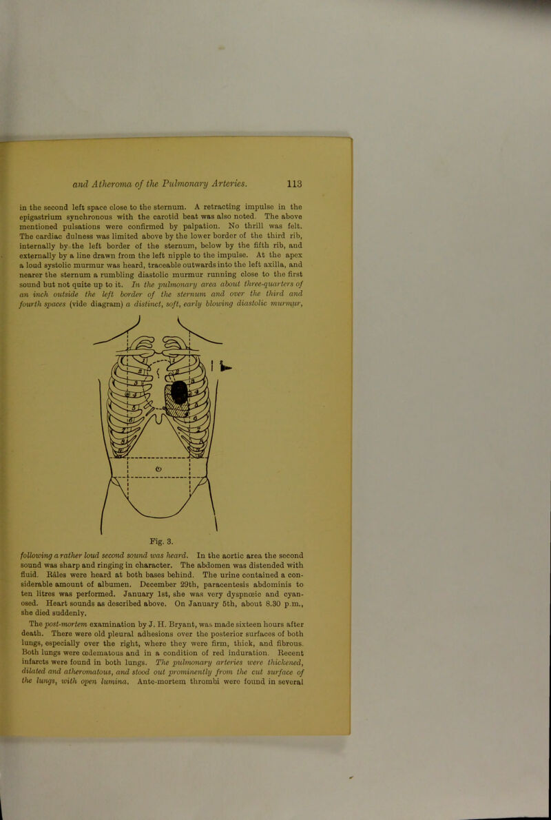 in the second left space close to the sternum. A retracting impulse in the epigastrium synchronous with the carotid beat was also noted. The above mentioned pulsations were confirmed by palpation. No thrill was felt. The cardiac dulness was limited above by the lower border of the third rib, internally by the left border of the sternum, below by the fifth rib, and externally by a line drawn from the left nipple to the impulse. At the apex a loud systolic murmur was heard, traceable outwards into the left axilla, and nearer the sternum a rumbling diastolic murmur running close to the first sound but not quite up to it. In the puhnonary area abottt three-quarters of an inch outside the left boj-der of the stermmi and over the third and fourth spaces (vide diagram) a distinct, soft, early blotving diastolic murmur. follcrwing a rather loud second sound was heard. In the aortic area the second sound was sharp and ringing in character. The abdomen was distended with fluid. E&les were heard at both bases behind. The urine contained a con- siderable amount of albumen. December 29th, paracentesis abdominis to ten litres was performed. January 1st, she was very dyspnoeic and cyan- osed. Heart sounds as described above. On January 5th, about 8.30 p.m., she died suddenly. The post-mortem examination by J. H. Bryant, was made sixteen hours after death. There were old pleural adhesions over the posterior surfaces of both lungs, especially over the right, where they were firm, thick, and fibrous. Both lungs were cedematous and in a condition of red induration. Recent infarcts were found in both lungs. The pulmotmry arteries were thickened, dilated and atheronuitous, and stood out p/rominently from the cut surface of the lungs, with open lumina. Ante-mortem thrombi were found in several