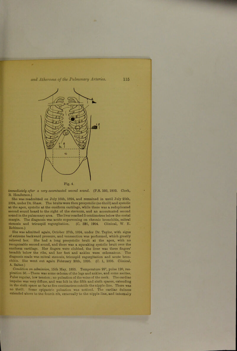 immediately after a very accentuated second sound. (P.S. 103, 1893, Clerk, R. Henderson.) She was readmitted on July 16th, 1894, and remained in until July 25th, 1894, under Dr. Shaw. The bruits were then presystolic (no thrill) and systolic at the apex, systolic at the ensiform cartilage, while there was a reduplicated second sound heard to the right of the sternum, and an accentuated second sound in the pulmonary area. The liver reached 5 centimetres below the costal margin. The diagnosis was acute supervening on chronic bronchitis, mitral stenosis and tricuspid regurgitation. (C, 336, 1994. Clinical, W. E. Robinson.) She was admitted again, October 27th, 1894, under Dr. Taylor, with signs of extreme backward pressure, and venesection was performed, which greatly relieved her. She had a long presystolic bruit at the apex, with no recognisable second sound, and there was a squeaking systolic bruit over the ensiform cartilage. Her fingers were clubbed, the liver was three fingers’ breadth below the ribs, and her feet and ankles were oedematous. The diagnosis made was mitral stenosis, tricuspid regurgitation and acute bron- chitis. She went out again February 20th, 1895. (C. 1, 1895. Clinical, A. Salter.) Cotulition on admission, 15th May, 1895. Temperature 99°, pulse 120, res- piration 56.—There was some oedema of the legs and ankles, and some ascites. Pulse regular, low tension; no pulsation of the veins of the neck. The cardiac impulse was very diffuse, and was felt in the fifth and sixth spaces, extending in the sixth space as far as five centimetres outside the nipple-line. There was no thrill. Some epigastric pulsation was noticed. The cardiac dulness extended above to the fourth rib, externally to the nipple-line, and internally