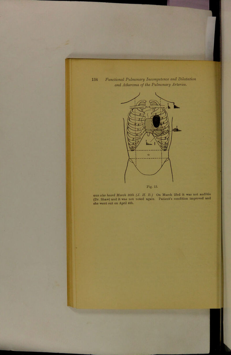 and Atheroma of the Pidmonary Arteries. Fig. 13. was also heard March 20th (J. H. B.) On March 23rd it was not audible (Dr. Shaw) and it was not noted again. Patient’s condition improved and she went out on April 4th.