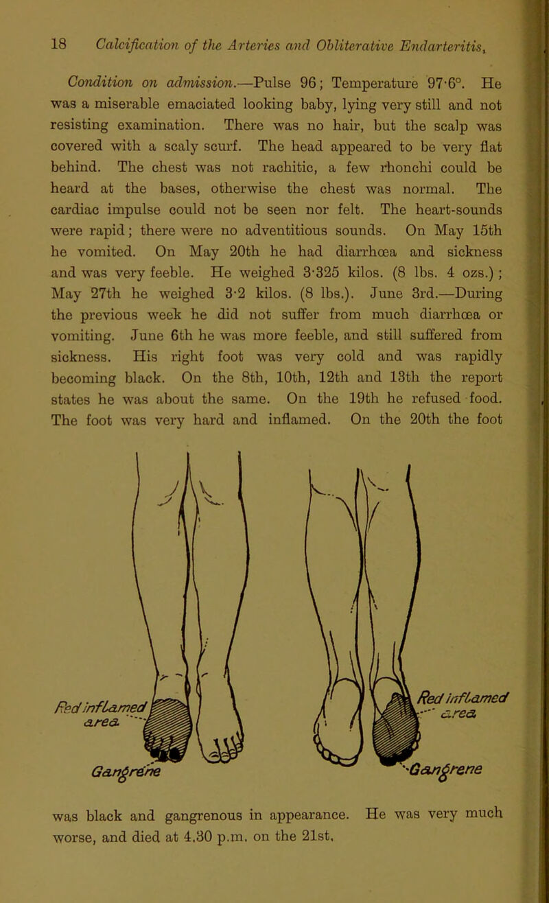 Condition on admission.—Pulse 96; Temperature 97-6°. He was a miserable emaciated looking baby, lying very still and not resisting examination. There was no hair, but the scalp was covered with a scaly scurf. The head appeared to be very flat behind. The chest was not rachitic, a few rhonchi could be heard at the bases, otherwise the chest was normal. The cardiac impulse could not be seen nor felt. The heart-sounds were rapid; there were no adventitious sounds. On May 15th he vomited. On May 20th he had diarrhoea and sickness and was very feeble. He weighed 3325 kilos. (8 lbs. 4 ozs.); May 27th he weighed 3'2 kilos. (8 lbs.). June 3rd.—During the previous week he did not suffer from much diarrhoea or vomiting. June 6th he was more feeble, and still suffered from sickness. His right foot was very cold and was rapidly becoming black. On the 8th, 10th, 12th and 13th the report states he was about the same. On the 19th he refused food. J The foot was very hard and inflamed. On the 20th the foot was black and gangrenous in appearance. He was very much worse, and died at 4,30 p.m. on the 21st, Redir <3. Red inflamed tr  area