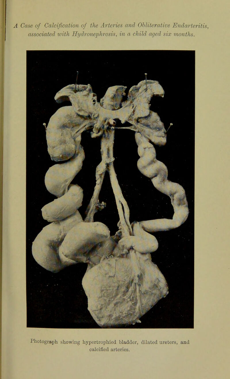 associated with Hydronephrosis, in a. child aged six months. Photograph showing hypertrophied bladder, dilated ureters, and calcified arteries.