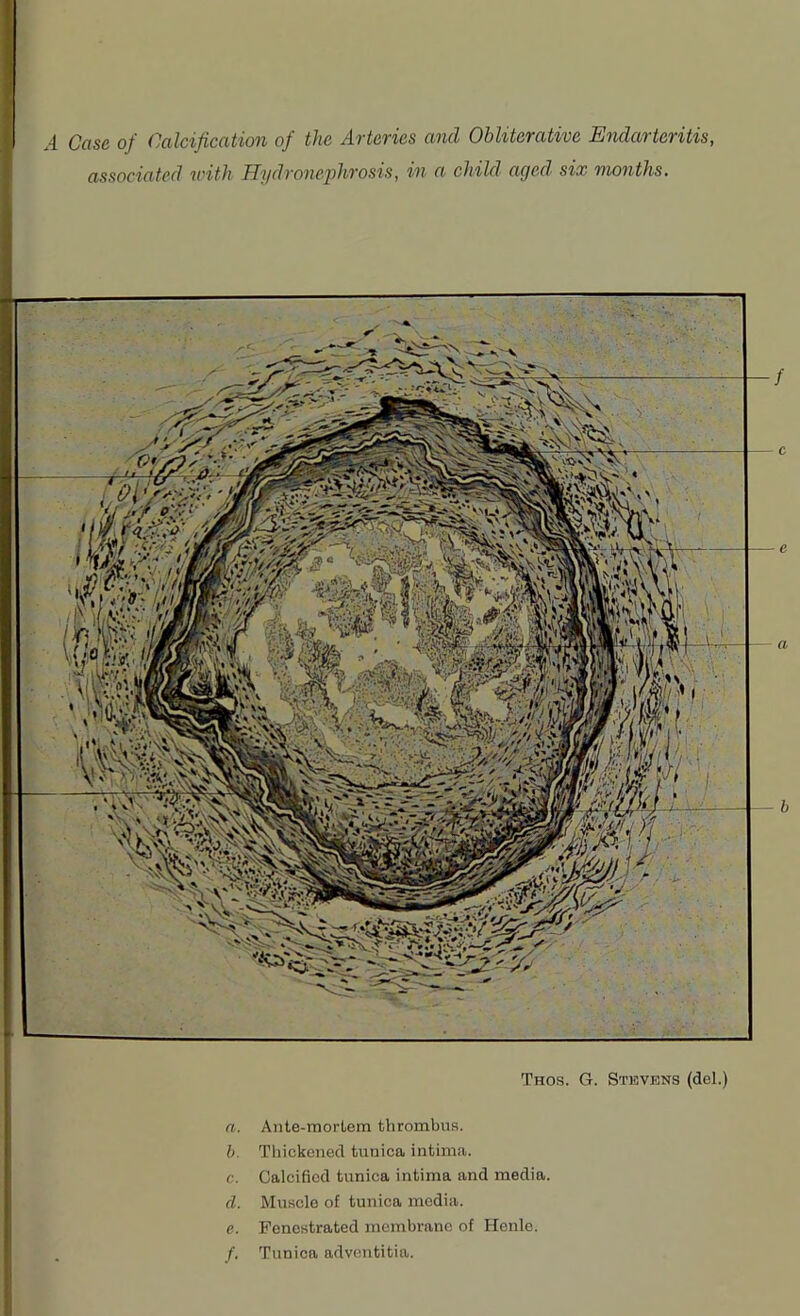 associated with Hydronephrosis, in a child aged six months. e Thos. G. Stevens (del.) a. Ante-mortem thrombus. b. Thickened tunica intima. c. Calcified tunica intima and media. cl. Muscle of tunica media. e. Fenestrated membrane of Henle. /. Tunica adventitia.