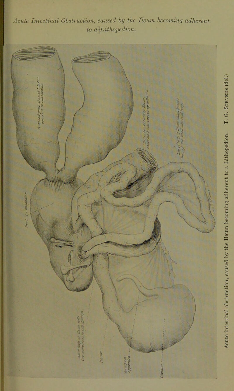 Acute Intestinal Obstruction, caused by the Ileiivi becoming adherent to a ^Lithopedion. Acute intestinal obstruction, caused by the Ileum becoming adherent to a Lithopedion. T. G. Stevens (del.)