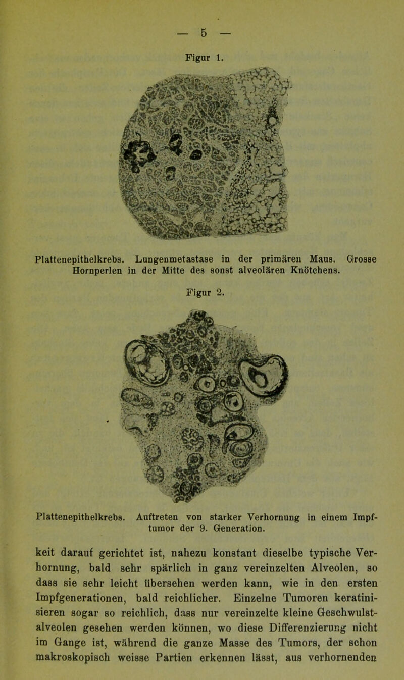 Figur 1. Plattenepithelkrebs. Lungenmetastase in der primären Maus. Grosse Hornperlen in der Mitte des sonst alveolären Knötchens. Figur 2. Plattenepithelkrebs. Auftreten von starker Verhornung in einem Impf- tumor der 9. Generation. keit darauf gerichtet ist, nahezu konstant dieselbe typische Ver- hornung, bald sehr spärlich in ganz vereinzelten Alveolen, so dass sie sehr leicht übersehen werden kann, wie in den ersten Impfgenerationen, bald reichlicher. Einzelne Tumoren keratini- sieren sogar so reichlich, dass nur vereinzelte kleine Geschwulst- alveolen gesehen werden können, wo diese Diflferenzierung nicht im Gange ist, während die ganze Masse des Tumors, der schon makroskopisch weisse Partien erkennen lässt, aus verhornenden