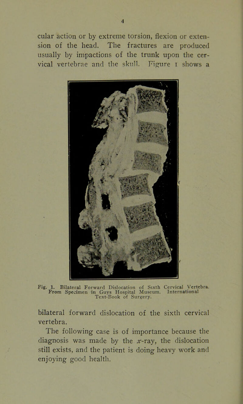 cular action or by extreme torsion, flexion or exten- sion of the head. The fractures are produced usually by impactions of the trunk upon the cer- vical vertebrae and the skull. Figure i shows a Fig. 1. Bilateral Forward Dislocation of Sixth Cervical Vertebra. From Specimen in Guys Hospital Museum. International Text-Book of Surgery. bilateral forward dislocation of the sixth cervical vertebra. The following case is of importance because the diagnosis was made by the x-ray, the dislocation still exists, and the patient is doing heavy work and enjoying good health.