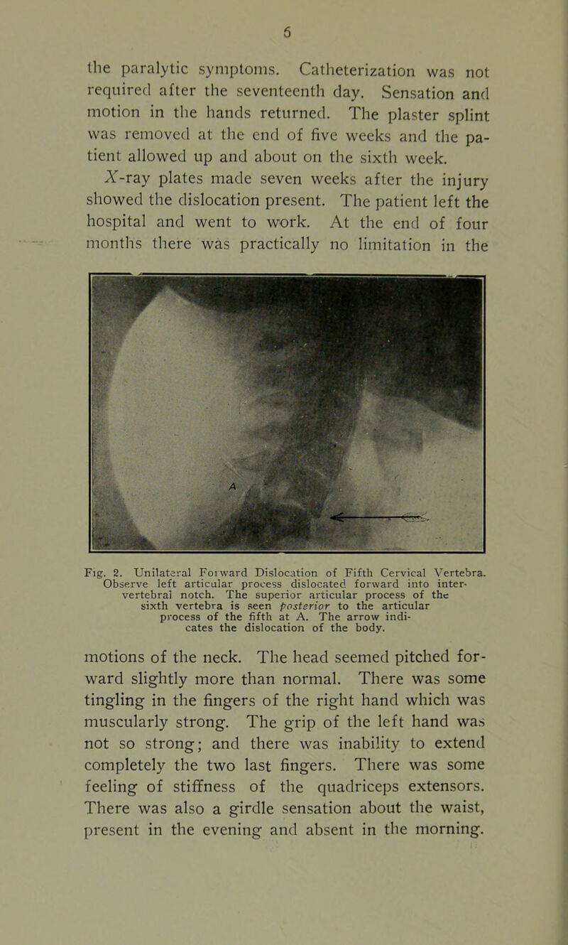 5 the paralytic symptoms. Catheterization was not required after the seventeenth day. Sensation and motion in the hands returned. The plaster splint was removed at the end of five weeks and the pa- tient allowed up and about on the sixth week. X-ray plates made seven weeks after the injury showed the dislocation present. The patient left the hospital and went to work. At the end of four months there was practically no limitation in the Fig. 2. Unilateral Forward Dislocation of Fifth Cervical Vertebra. Observe left articular process dislocated forward into inter- vertebral notch. The superior articular process of the sixth vertebra is seen posterior to the articular process of the fifth at A. The arrow indi- cates the dislocation of the body. motions of the neck. The head seemed pitched for- ward slightly more than normal. There was some tingling in the fingers of the right hand which was muscularly strong. The grip of the left hand was not so strong; and there was inability to extend completely the two last fingers. There was some feeling of stiffness of the quadriceps extensors. There was also a girdle sensation about the waist, present in the evening and absent in the morning.