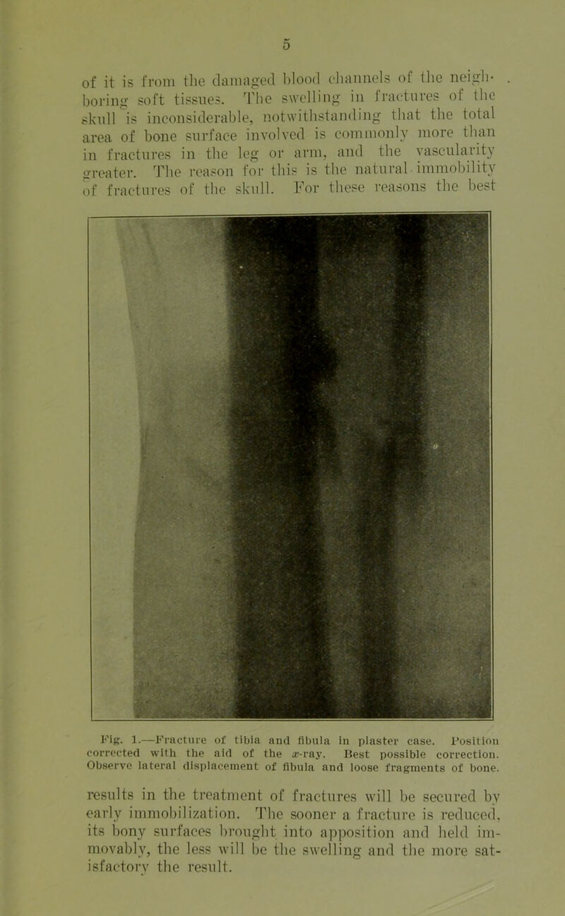 0 of it is from tlio damao'ed Mood cliaimels of the neigli- boring- soft tissues. The swelling in fractures of the skull is inconsiderable, notwithstanding that the total area of bone surface involved is commonly more than in fractures in the leg or arm, and the vascularity srreater. d’he i-eason for this is the natural immobility l)f fractures of the skull. For these reasons the best Fig. ].—Fracture of tibia and fibula in plaster case. I’osition corrected with the aid of the ®-ray. Best possible correction. Observe lateral displacement of fibula and loose fragments of bone. results in the treatment of fractures will be secured by early immobilization. The sooner a fracture is reduced, its hony surfaces brought into apposition and held im- movably, the less will be the swelling and the more sat- isfactory the result.