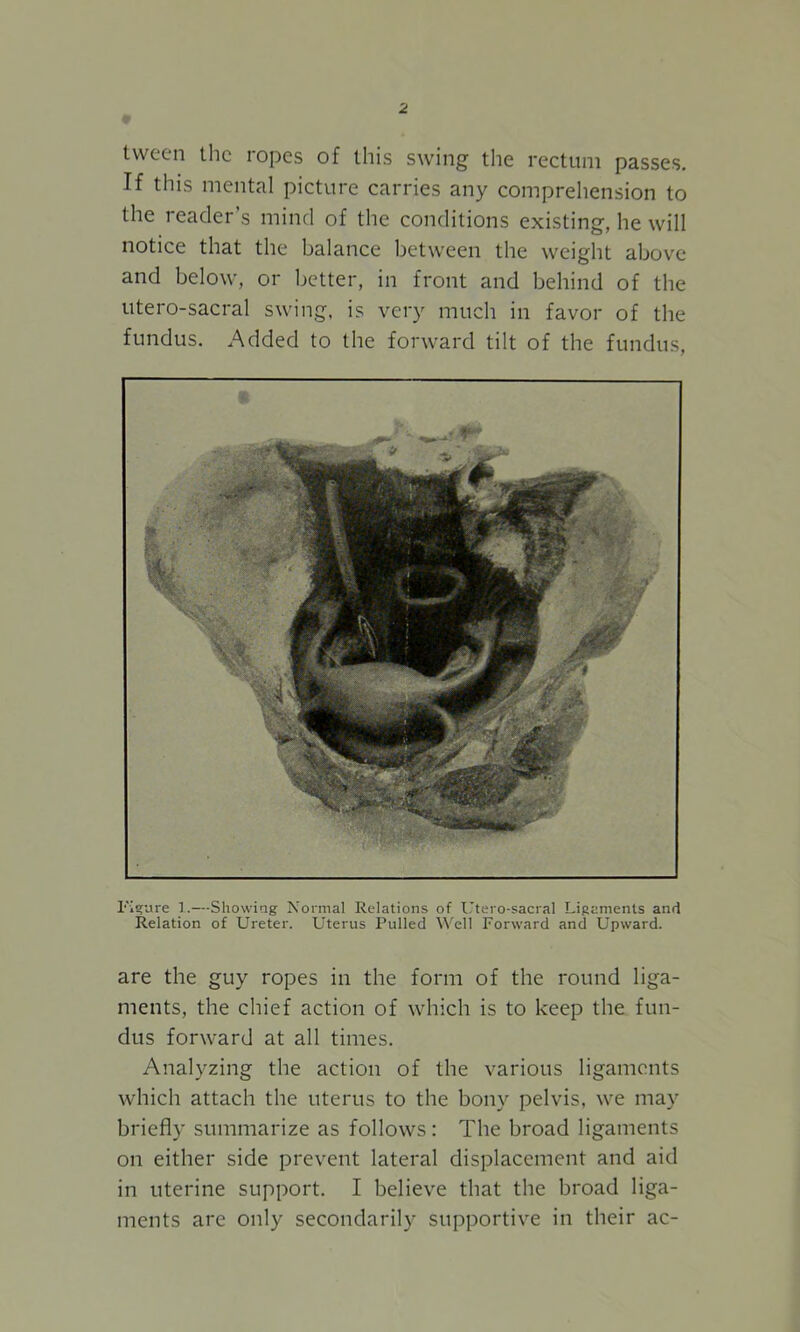 tvvec*n the ropes of this swing the rectum passes. If this mental picture carries any comprehension to the reader s mind of the conditions existing, he will notice that the balance between the weight above and below, or better, in front and behind of the utero-sacral swing, is very much in favor of the fundus. Added to the forward tilt of the fundus, Figure 1.—Showing Normal Relations of Utero-sacral Ligaments and Relation of Ureter. Uterus Pulled Well Forward and Upward. are the guy ropes in the form of the round liga- ments, the chief action of which is to keep the fun- dus forward at all times. Analyzing the action of the various ligaments which attach the uterus to the bony pelvis, we may briefly summarize as follows: The broad ligaments on either side prevent lateral displacement and aid in uterine support. I believe that the broad liga- ments are only secondarily supportive in their ac-