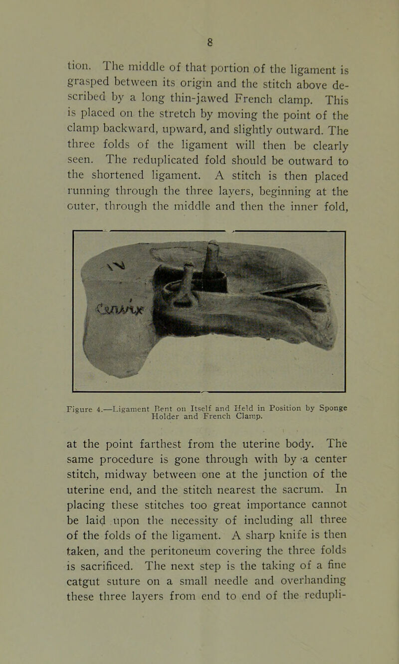 tion. 1 he middle of that portion of the ligament is grasped between its origin and the stitch above de- scribed by a long thin-jawed French clamp. This is placed on the stretch by moving the point of the clamp backward, upward, and slightly outward. The three folds of the ligament will then be clearly seen. The reduplicated fold should be outward to the shortened ligament. A stitch is then placed running through the three layers, beginning at the outer, through the middle and then the inner fold, Figure 4.—Ligament Rent on Itself and Held in Position by Sponge Holder and French Clamp. at the point farthest from the uterine body. The same procedure is gone through with by a. center stitch, midway between one at the junction of the uterine end, and the stitch nearest the sacrum. In placing these stitches too great importance cannot be laid upon the necessity of including all three of the folds of the ligament. A sharp knife is then taken, and the peritoneum covering the three folds is sacrificed. The next step is the taking of a fine catgut suture on a small needle and overhanding these three layers from end to end of the redupli-