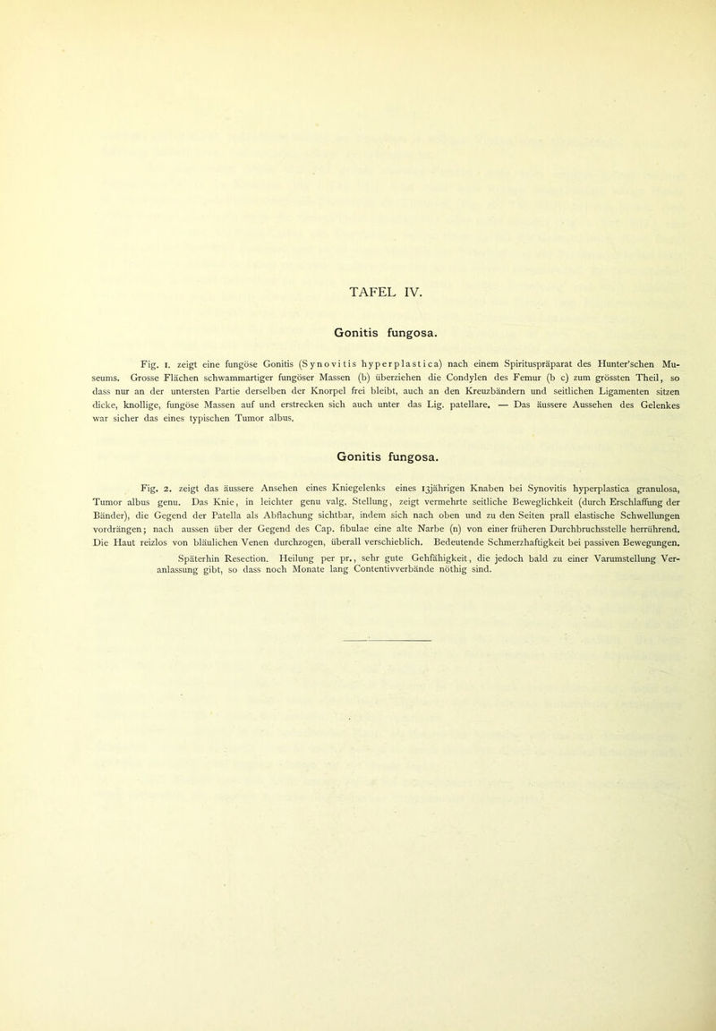 Gonitis fungosa. Fig. i. zeigt eine fungöse Gonitis (Synovitis hyperplastica) nach einem Spirituspräparat des Hunter’schen Mu- seums. Grosse Flächen schwammartiger fungöser Massen (b) überziehen die Condylen des Femur (b c) zum grössten Theil, so dass nur an der untersten Partie derselben der Knorpel frei bleibt, auch an den Kreuzbändern und seitlichen Ligamenten sitzen dicke, knollige, fungöse Massen auf und erstrecken sich auch unter das Lig. patellare. — Das äussere Aussehen des Gelenkes war sicher das eines typischen Tumor albus. Gonitis fungosa. Fig. 2. zeigt das äussere Ansehen eines Kniegelenks eines 13jährigen Knaben bei Synovitis hyperplastica granulosa, Tumor albus genu. Das Knie, in leichter genu valg. Stellung, zeigt vermehrte seitliche Beweglichkeit (durch Erschlaffung der Bänder), die Gegend der Patella als Abflachung sichtbar, indem sich nach oben und zu den Seiten prall elastische Schwellungen vordrängen; nach aussen über der Gegend des Cap. fibulae eine alte Narbe (n) von einer früheren Durchbruchsstelle herrührend. Die Haut reizlos von bläulichen Venen durchzogen, überall verschieblich. Bedeutende Schmerzhaftigkeit bei passiven Bewegungen. Späterhin Resection. Heilung per pr., sehr gute Gehfähigkeit, die jedoch bald zu einer Varumstellung Ver- anlassung gibt, so dass noch Monate lang Contentivverbände nöthig sind.